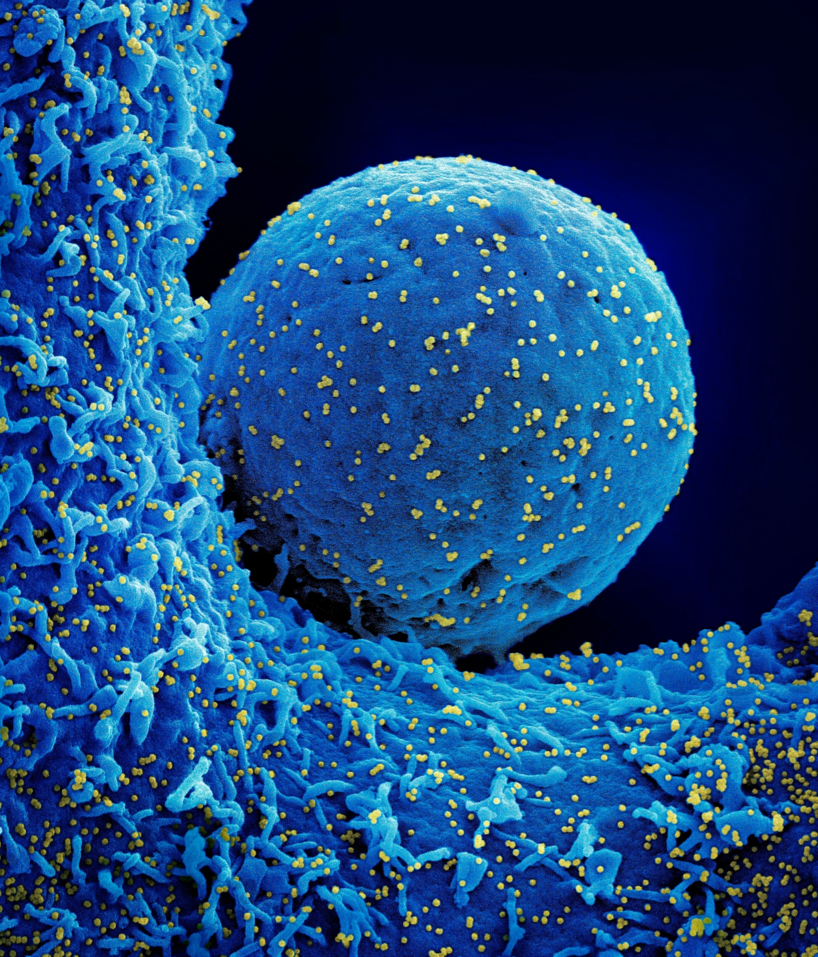 A colorized microscopic view of a round, blue cell, dotted with hundreds of small yellow dots, which are all COVID virus particles infecting the cell.