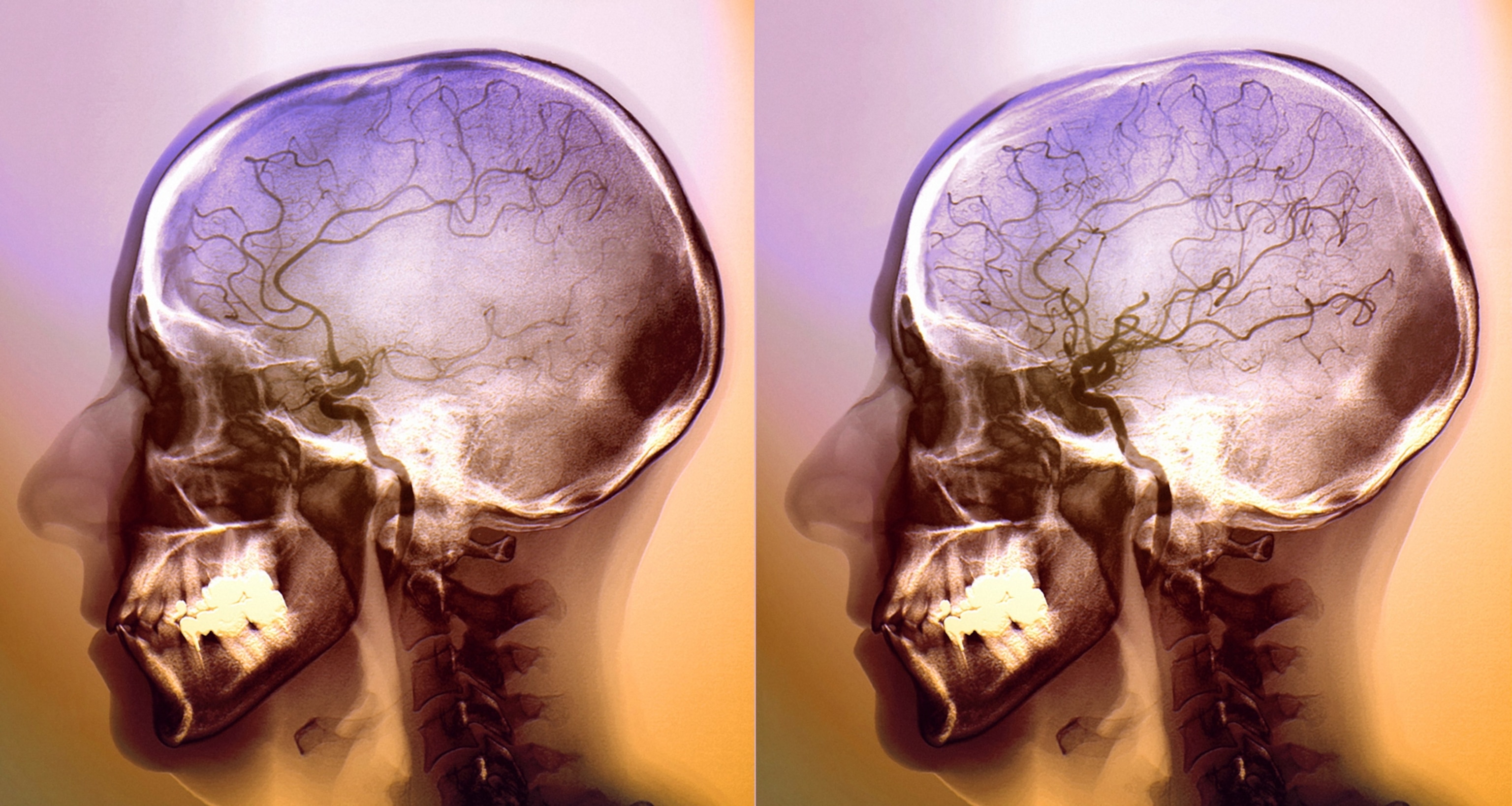A before and after x-ray with angiogram to show the blood vessels within a patient's brain during an ischemic stroke, and following treatment. In the before image, significantly fewer blood vessels are visible with the contract medium, but in the second image, far more blood vessels are visible.