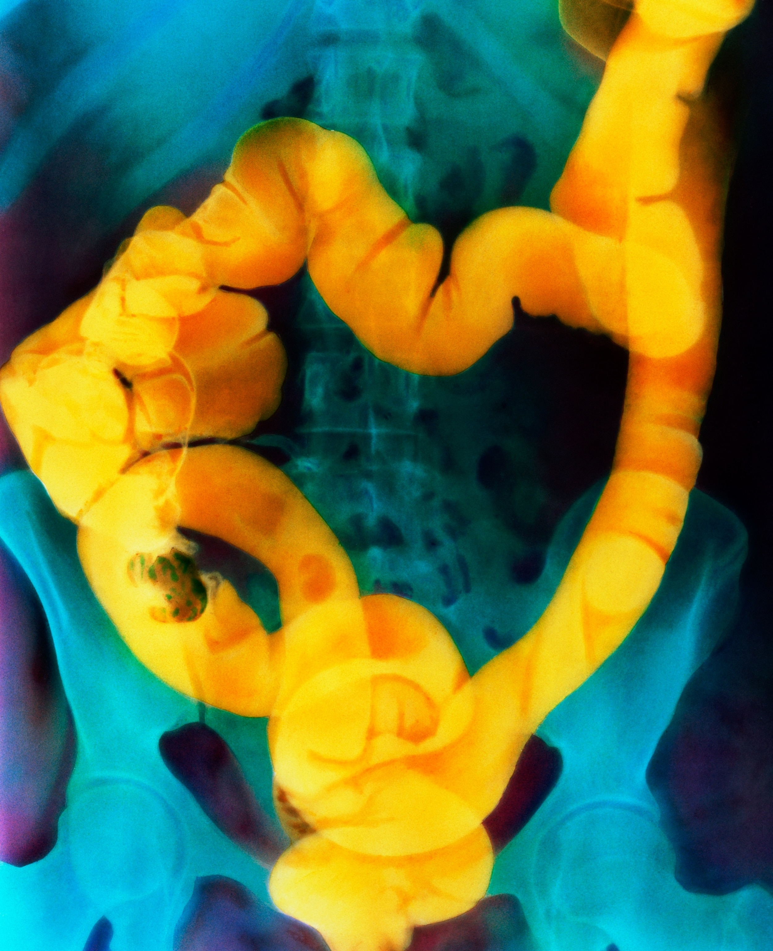 Colorized abdominal X-ray which shows orally given barium coating the GI tract to reveal lesions or obstructions.