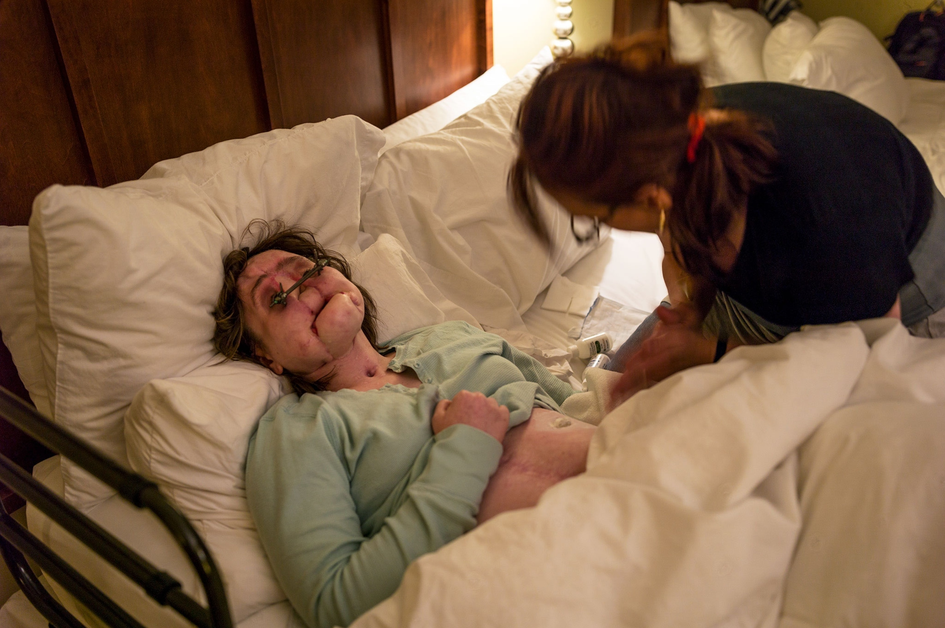 a woman awaiting a face transplant