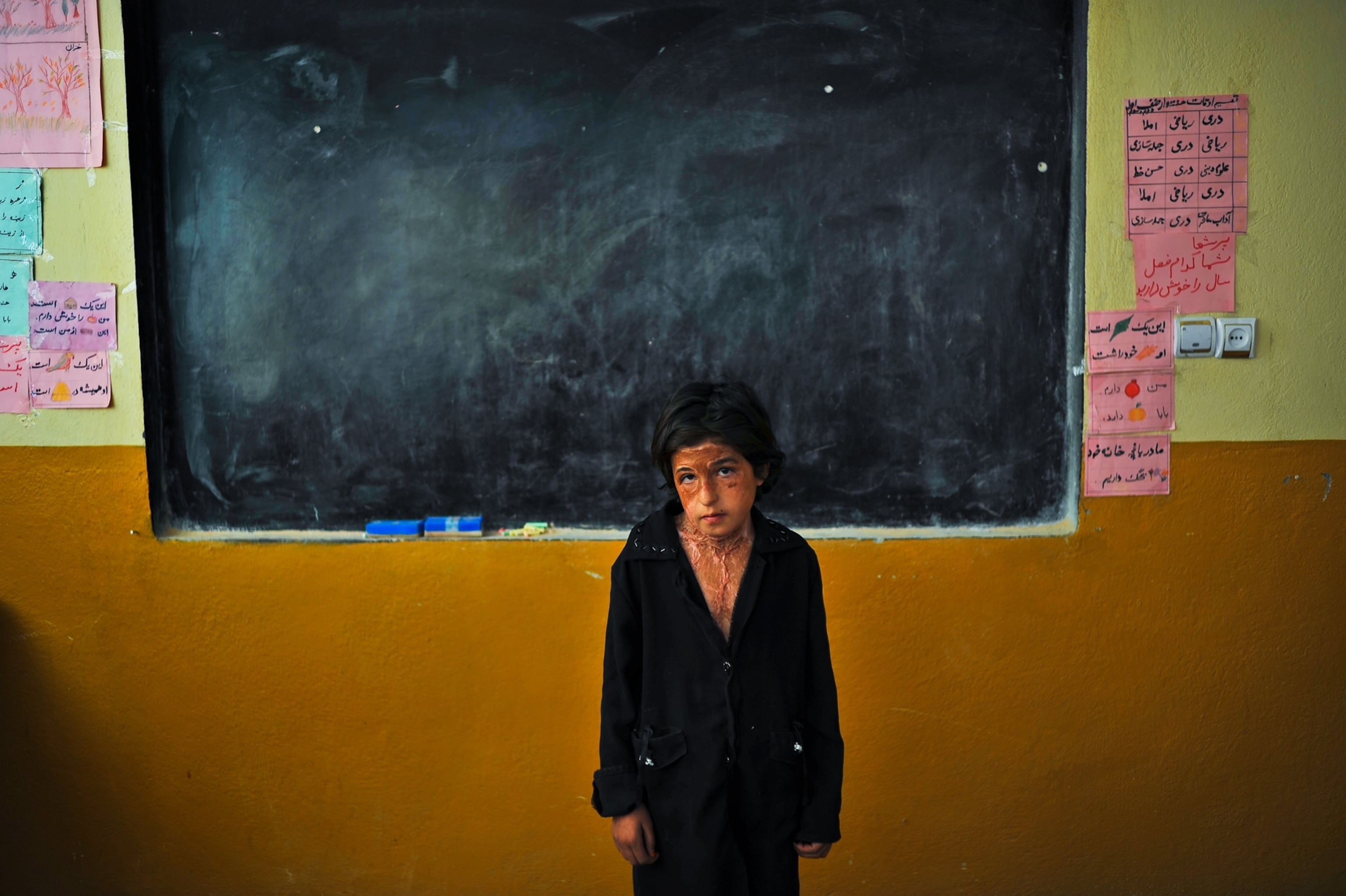 an eleven year old girl covered in burn marks from setting herself on fire