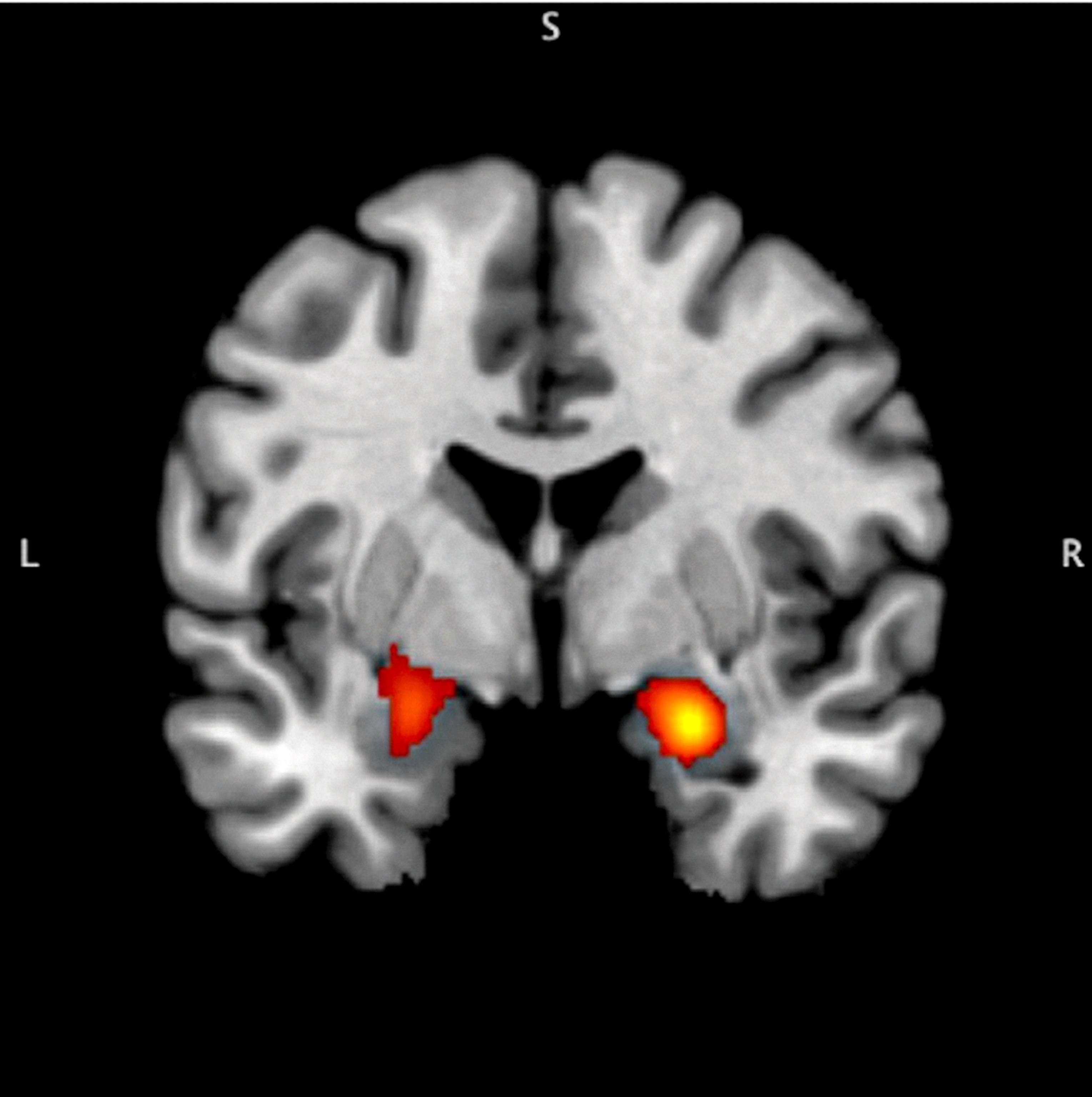 Monochromatic brain scan of a young girl highlights two sections in bright orange where emotional stimuli indicates signs of child maltreatment.