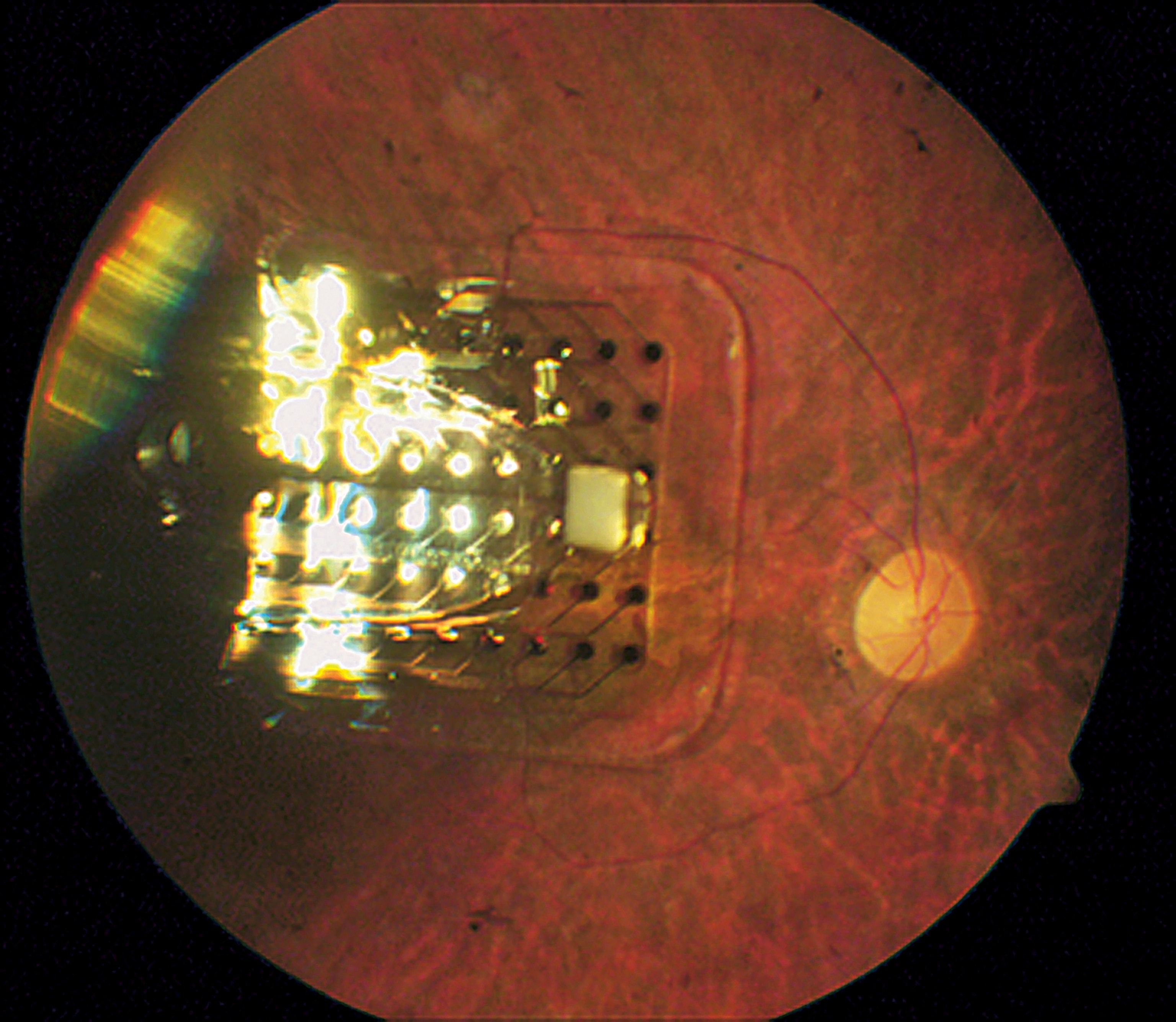 Retina