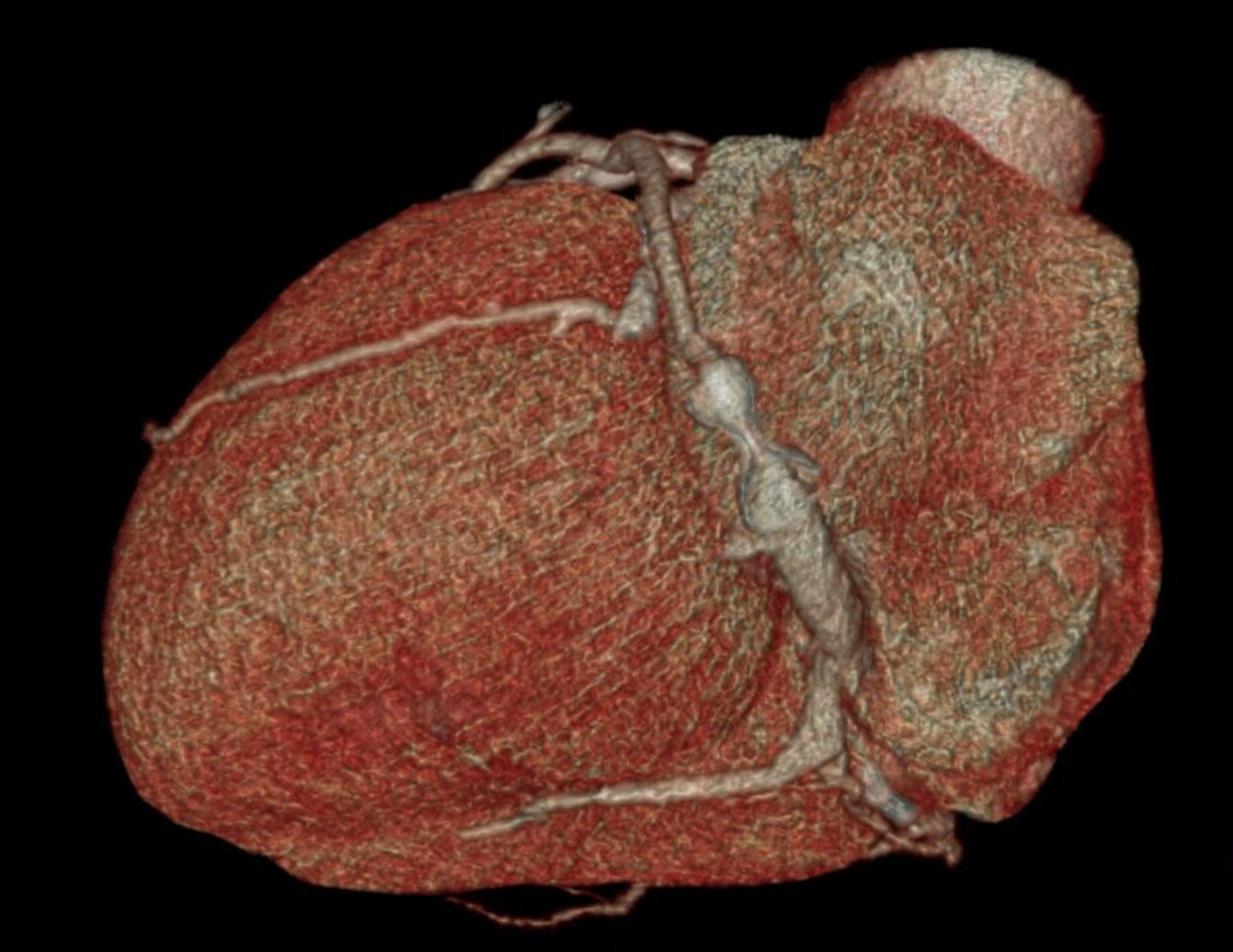 computer model of heart with visible implant.