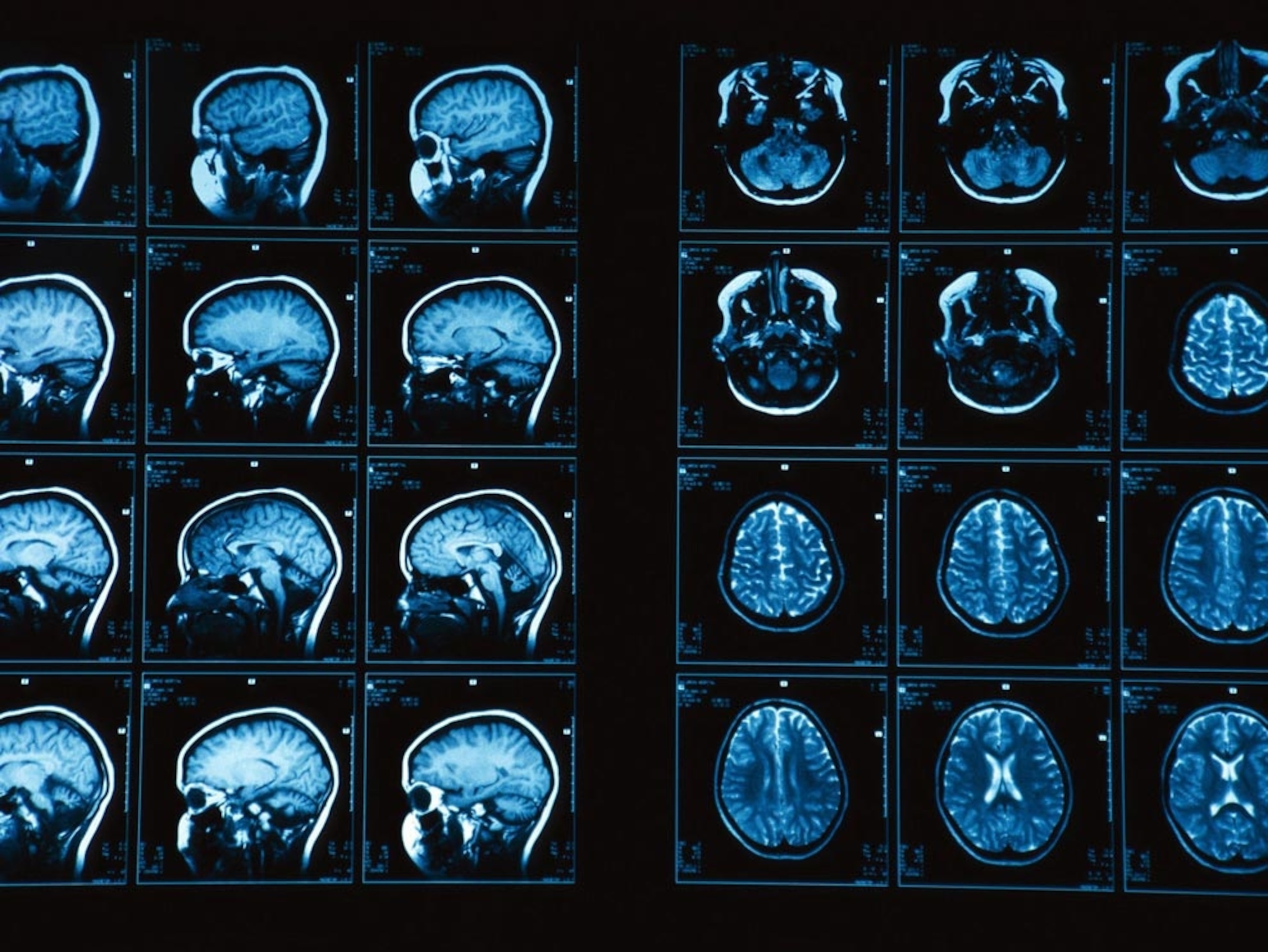 MRI scans of a human brain