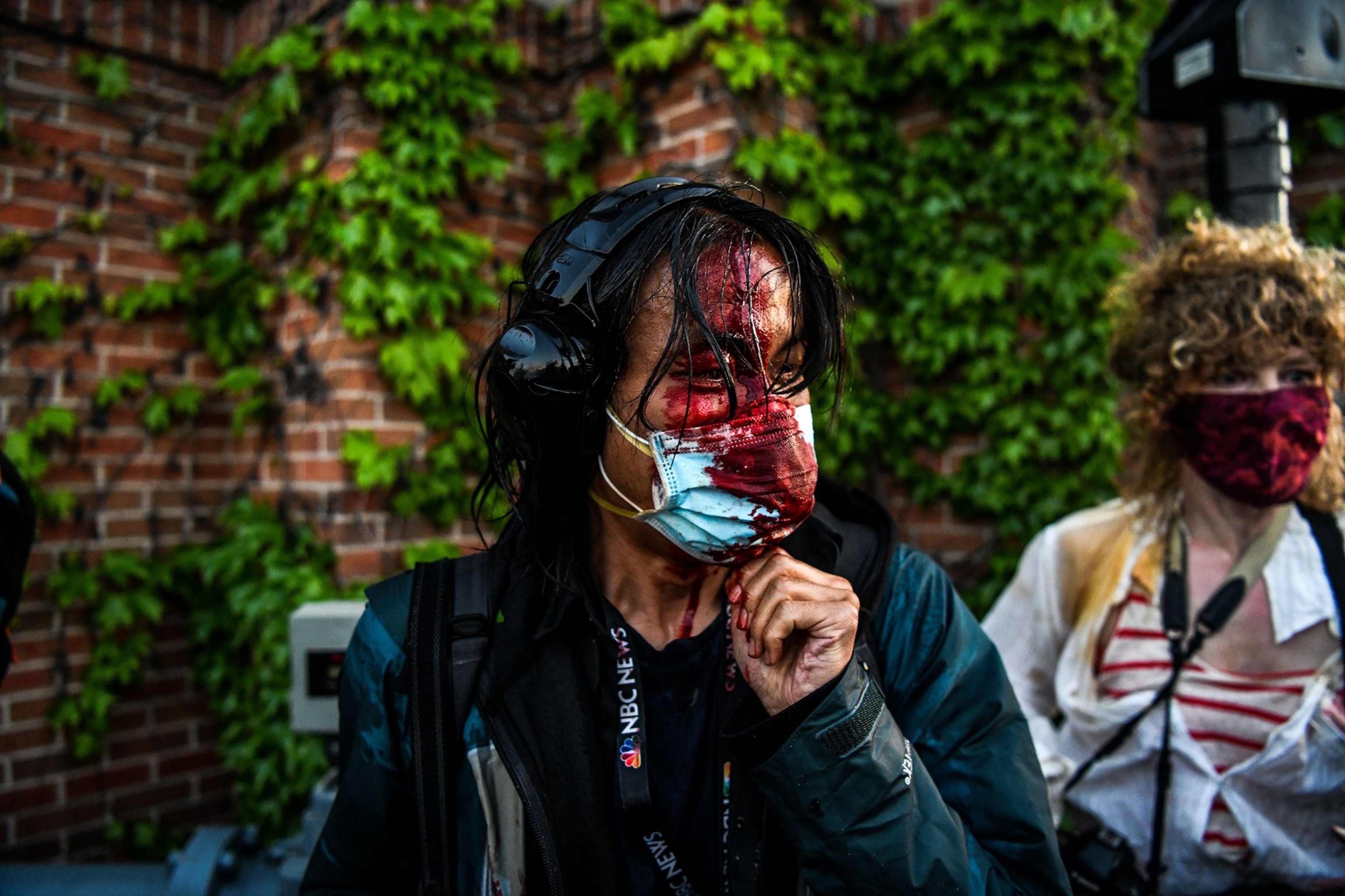 a journalist bleeding after being hit by rubber bullets
