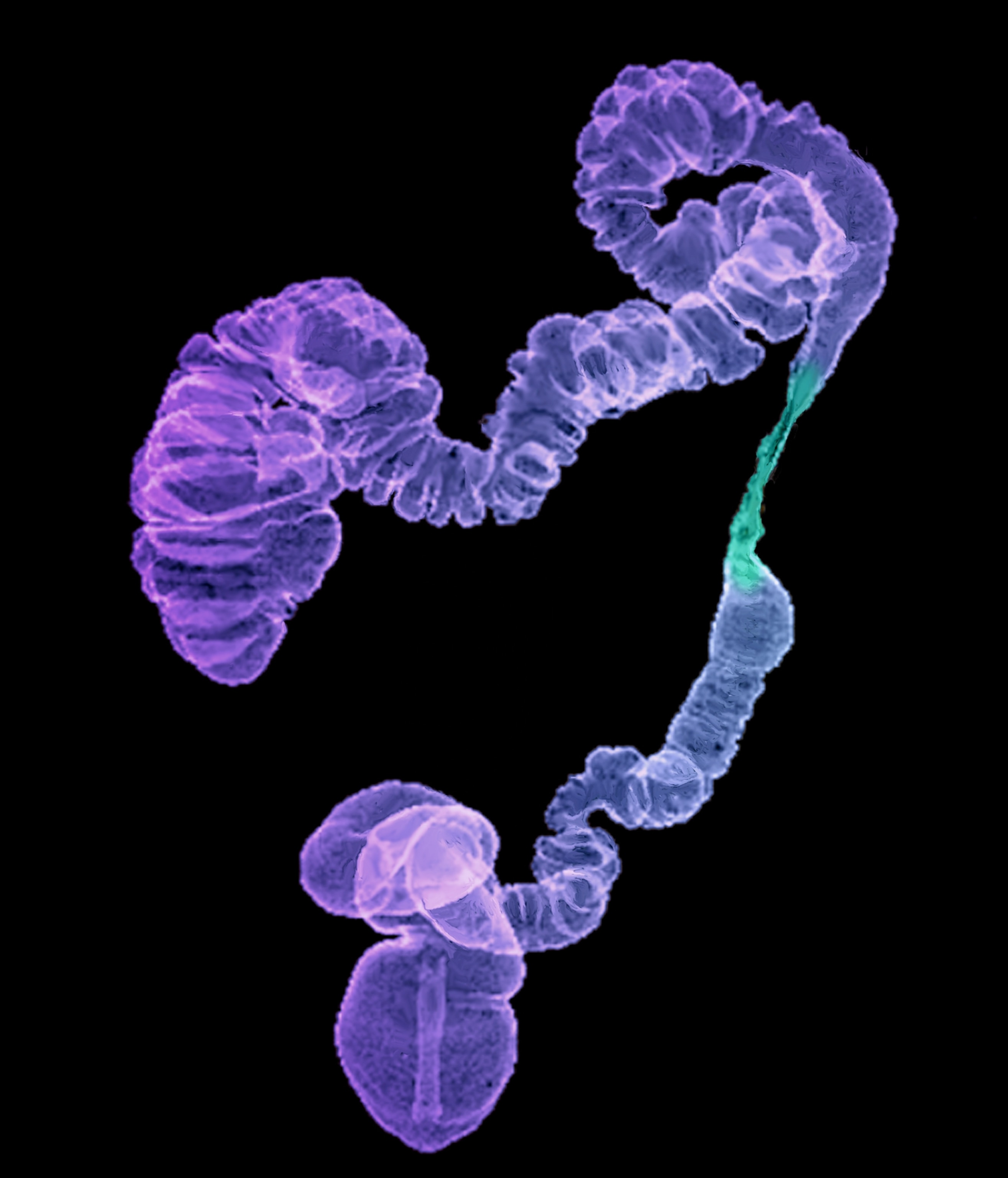 A colorized CT scan of a patient's large intestine and colon, with a noticeable narrowing of the organ, suggestive of cancer.