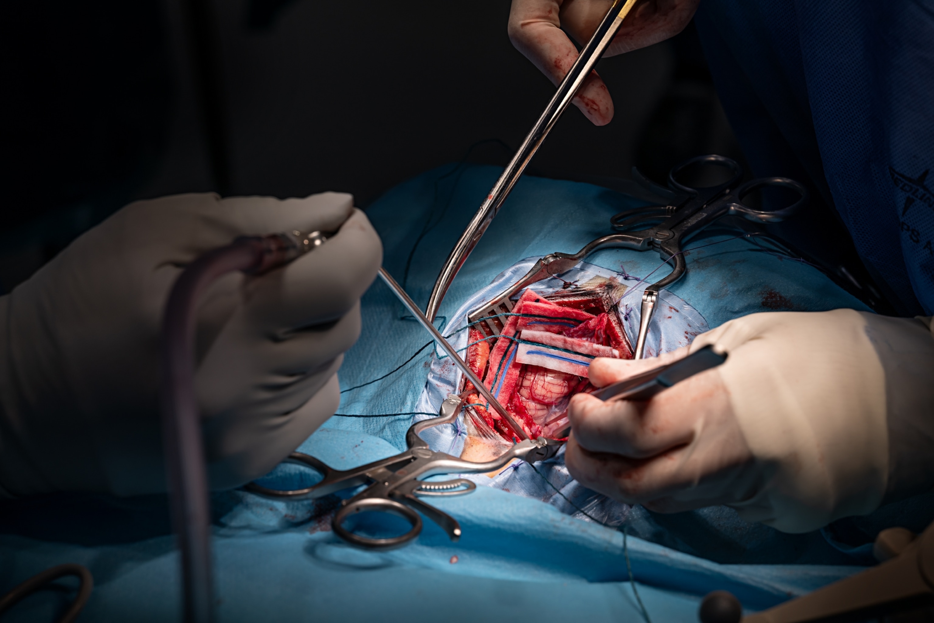 Three gloved hands hold surgical tools as they operate on a brain. The head of the patient is covered, only a small opening of the brain can be seen.
