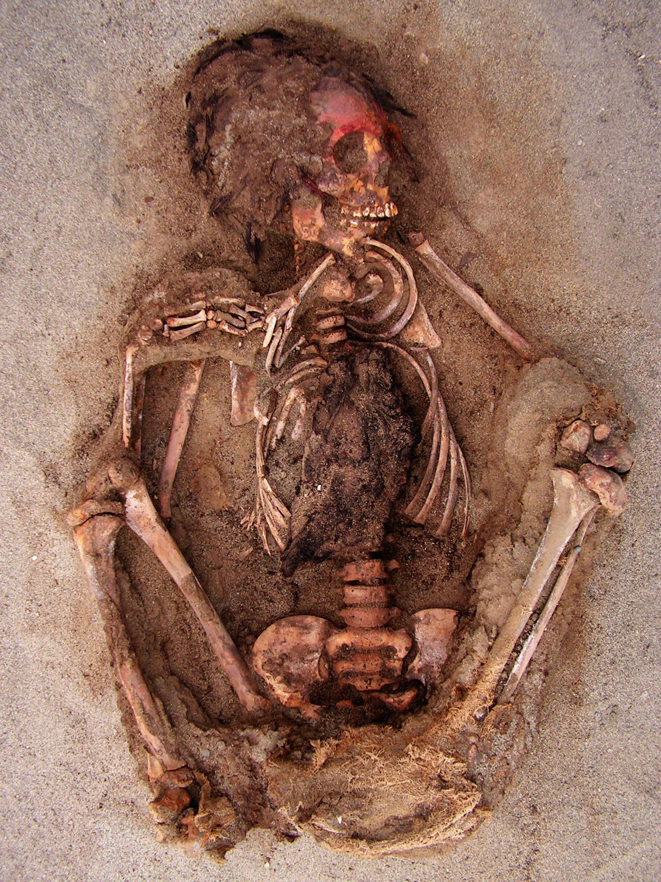 child body with open chest.