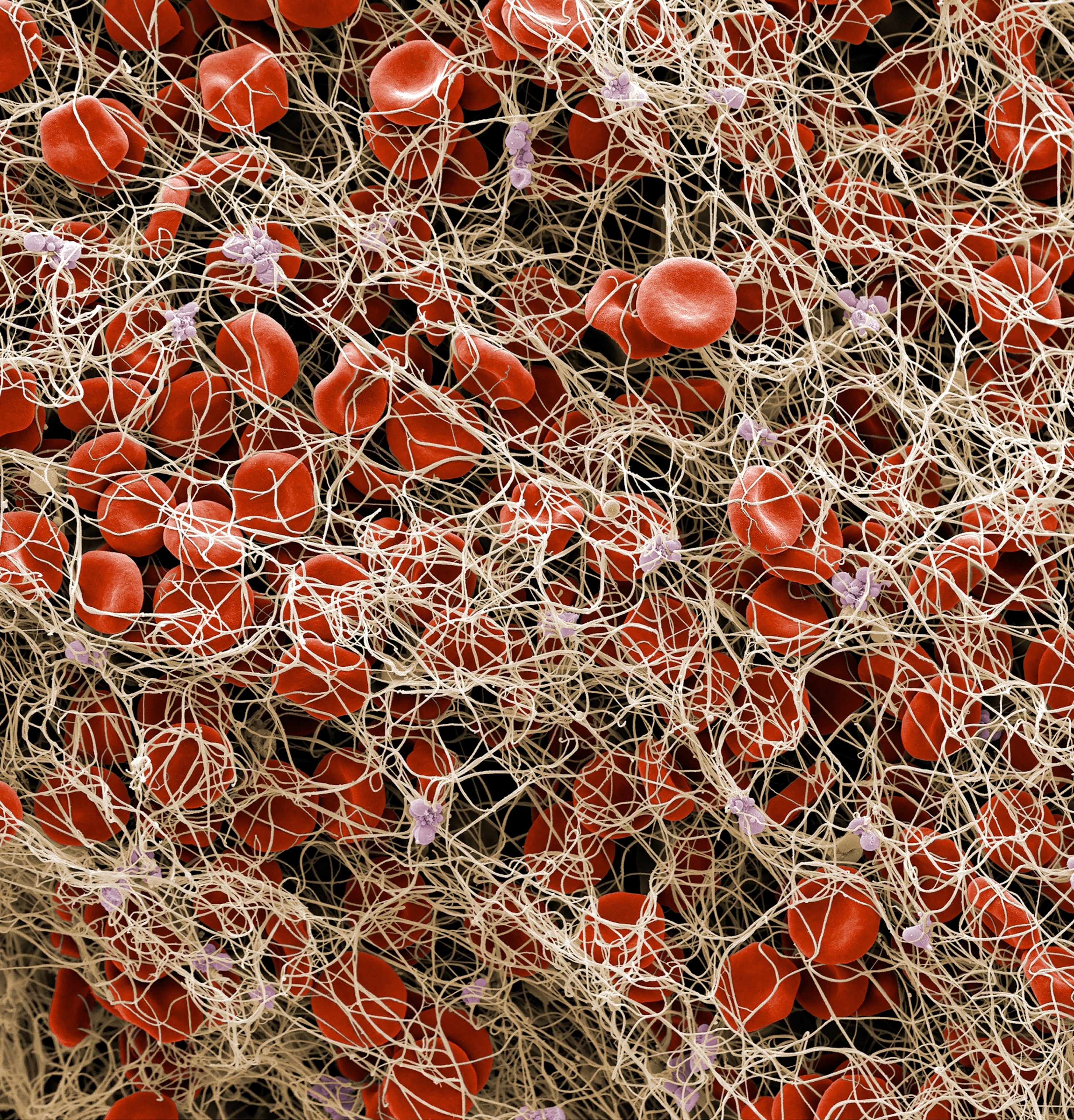 Colored scanning electron micrograph of a blood clot, showing red blood cells and platelets in a fibrin mesh.