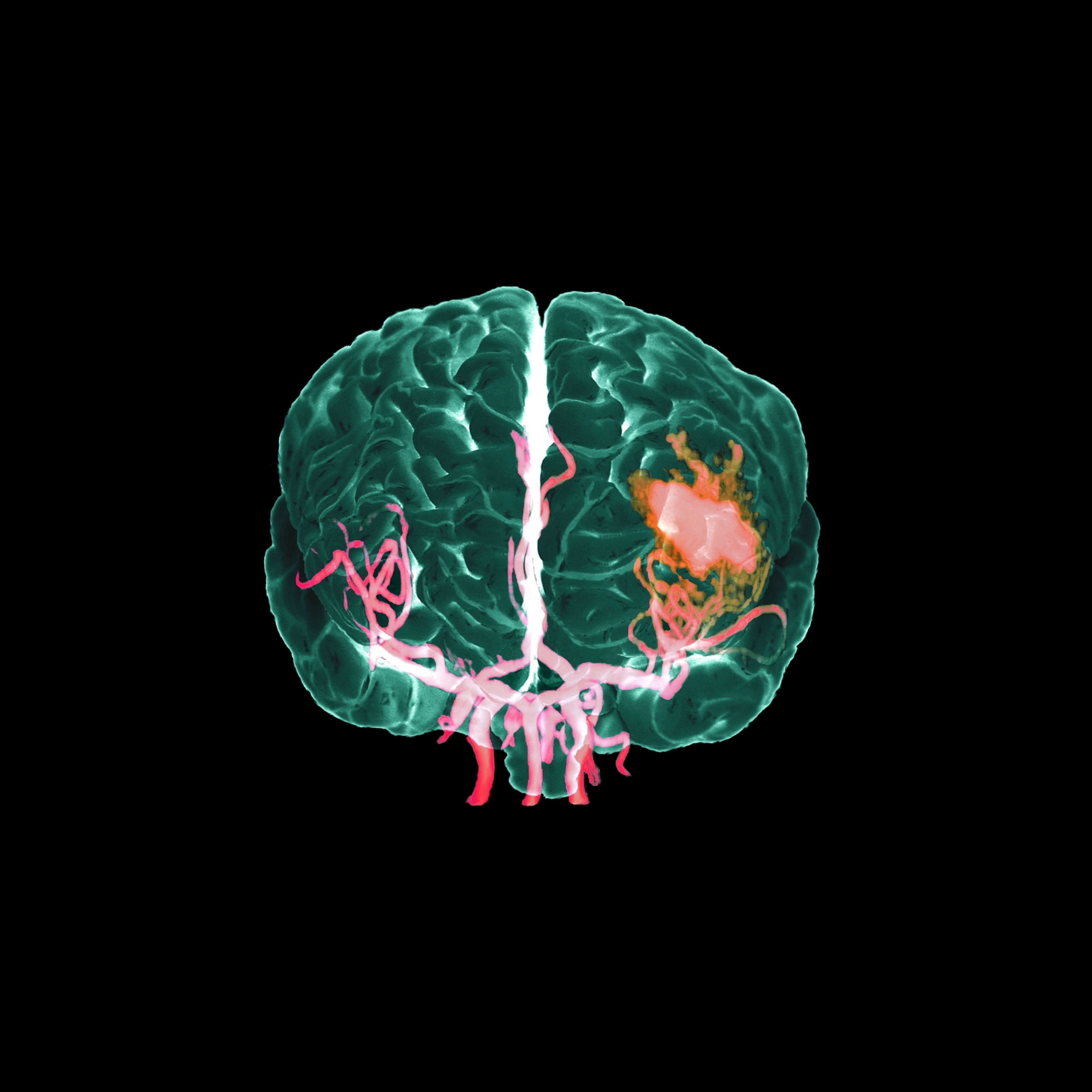 A colorized 3D model derived from a combination of MRI and angiogram to highlight the location of a bleed in a patient's brain. Towards the bottom of the image, blood vessels branch equally to the left and right. By mid-level in the brain, the clean lines of blood vessels on the right (patient's left) give way to a soupy pool of color, where blood is collecting.