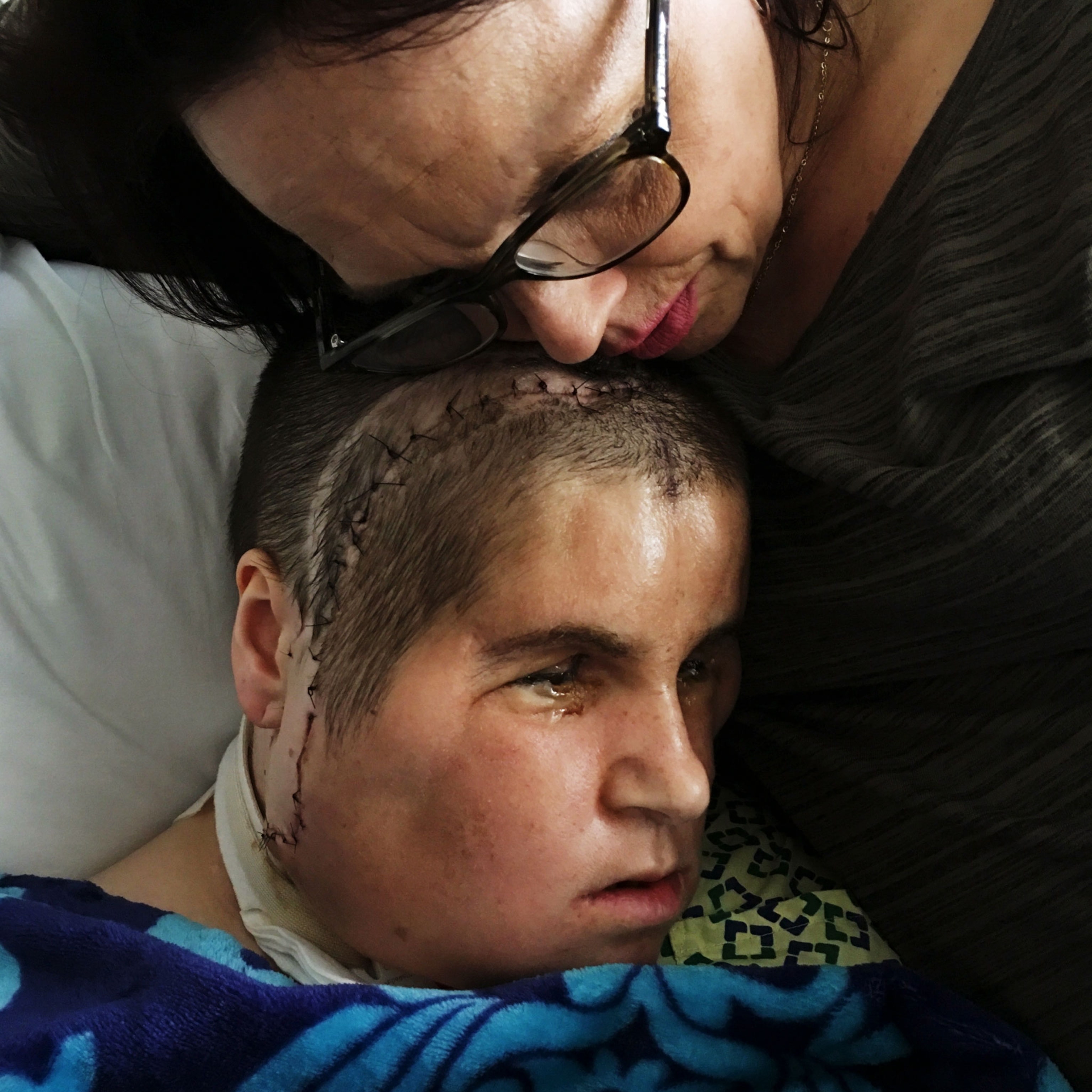 a woman after receiving a face transplant
