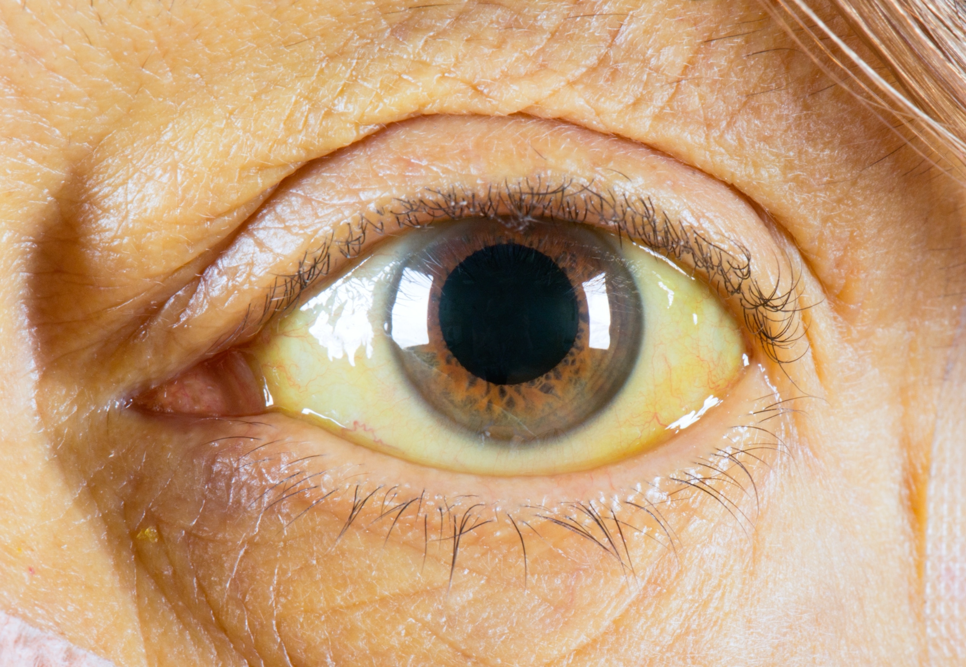 A close-up view of a woman's eye which has noticeable yellow-ing of the normally white sclera.