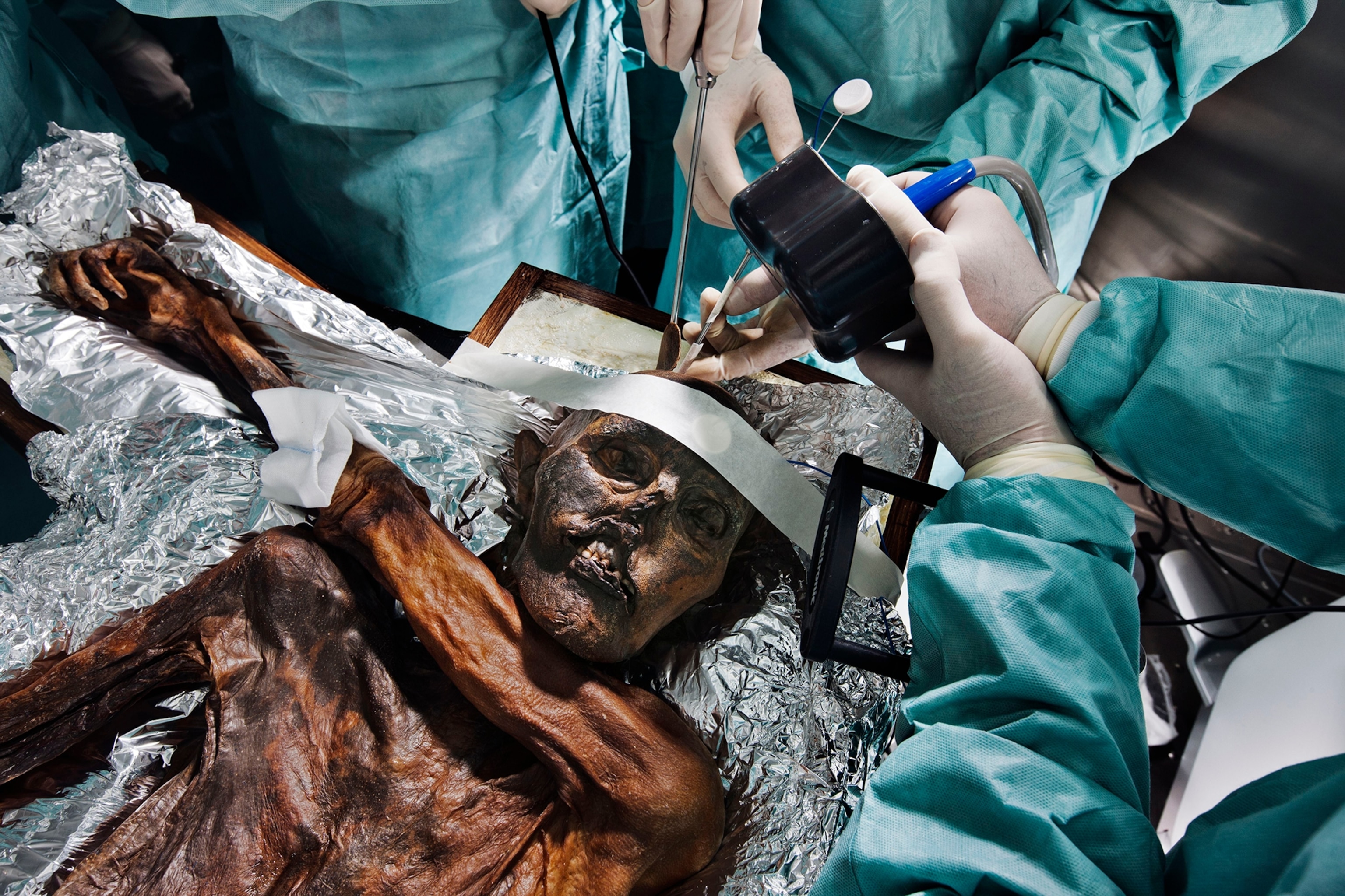 neurosurgeons working on the Iceman mummy