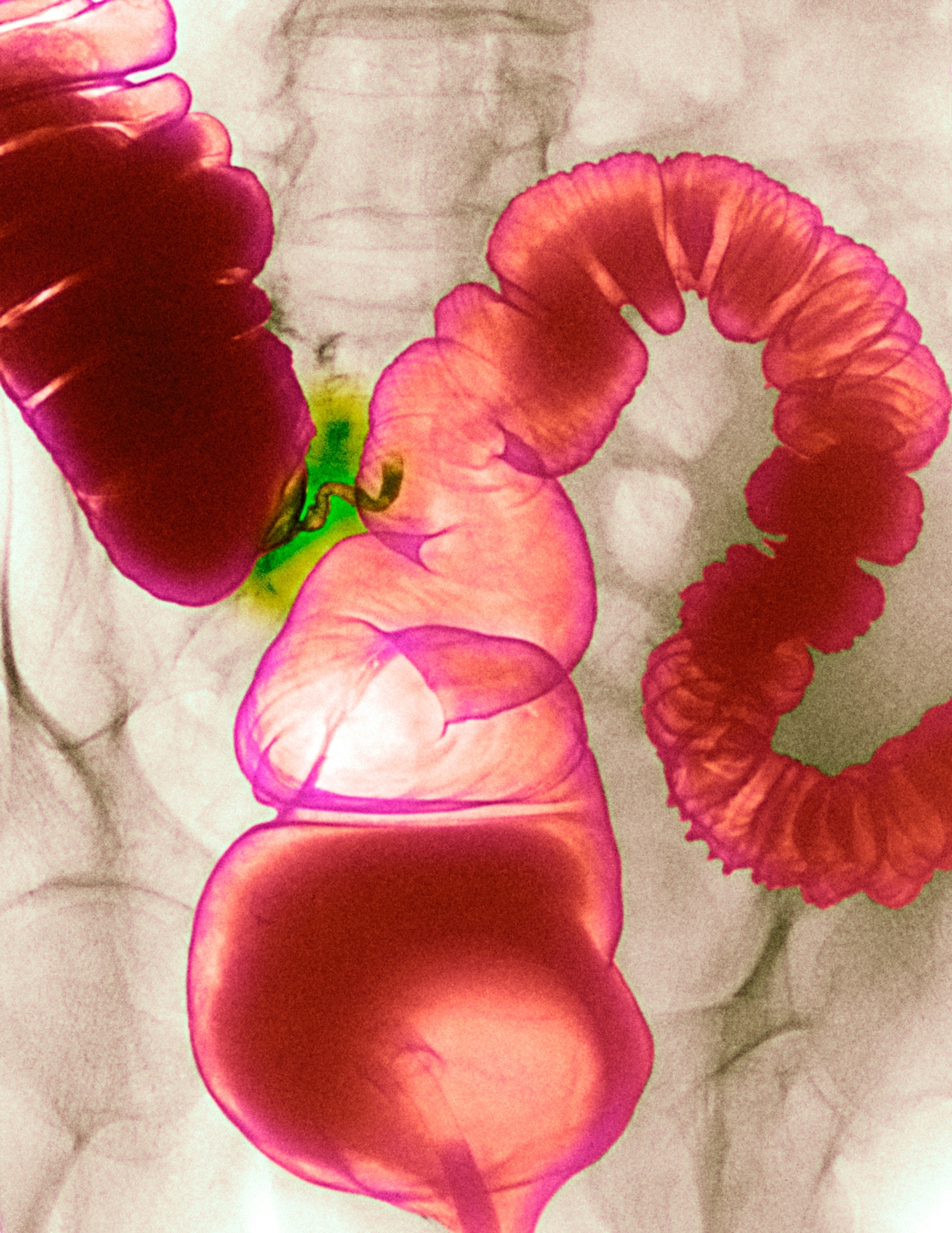 A colorized abdominal x-ray showing the large intestines in pink, with a section exhibiting drastic narrowing, highlighted in green.
