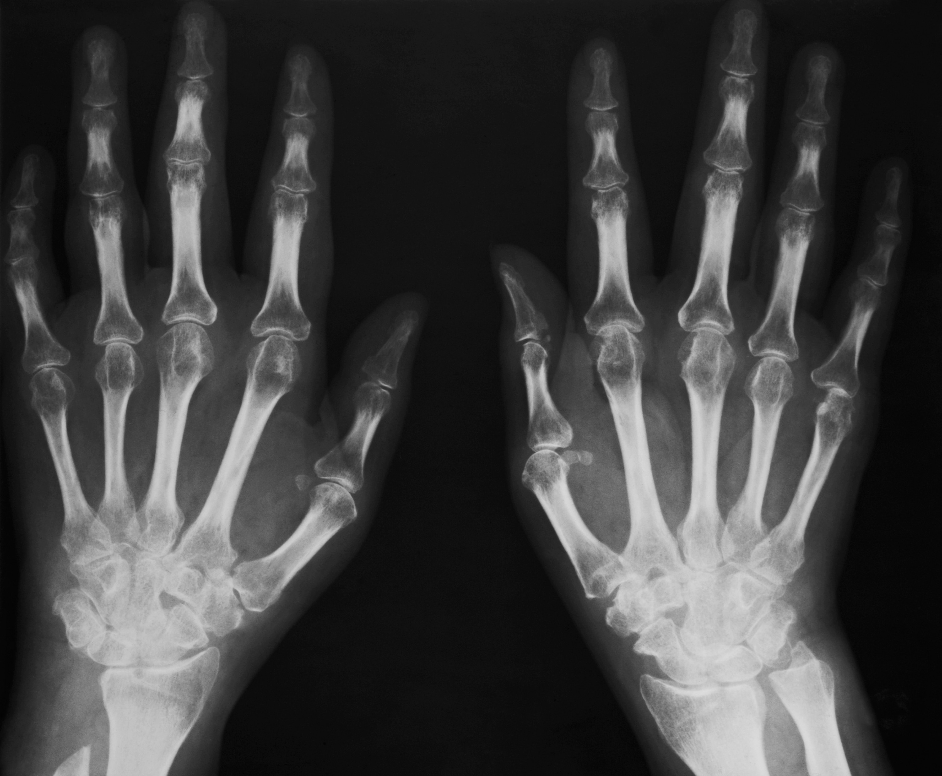 Photo of x-ray of hands with bent fingers