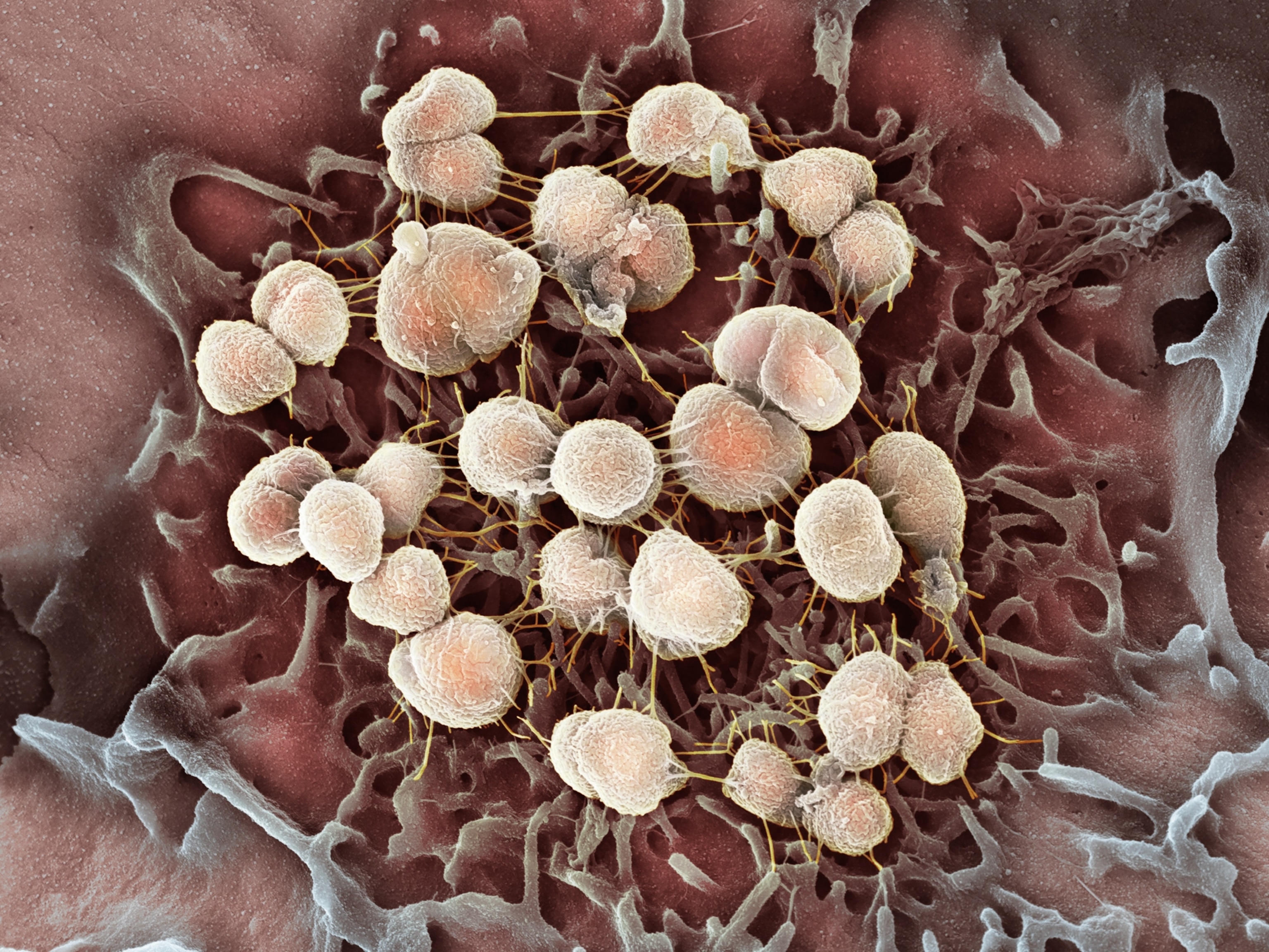 A colorized scanning electron micrograph showing a cluster of round gonorrhea bacteria clinging to the surface of another cell.