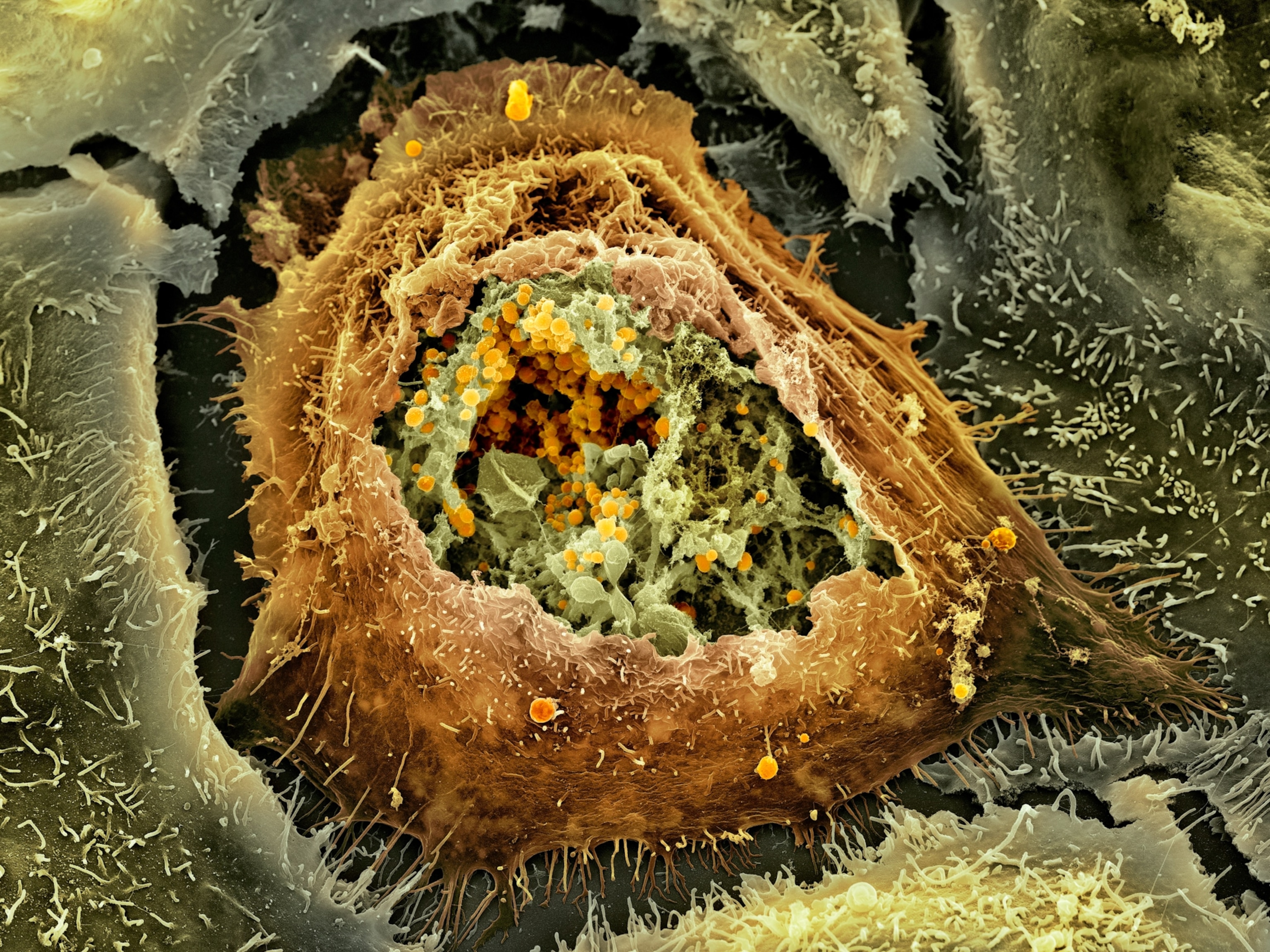 Colored scanning electron micrograph showing a cervix cell which appears ripped open. Inside, hundreds of round Chlamydia bacteria are visible.