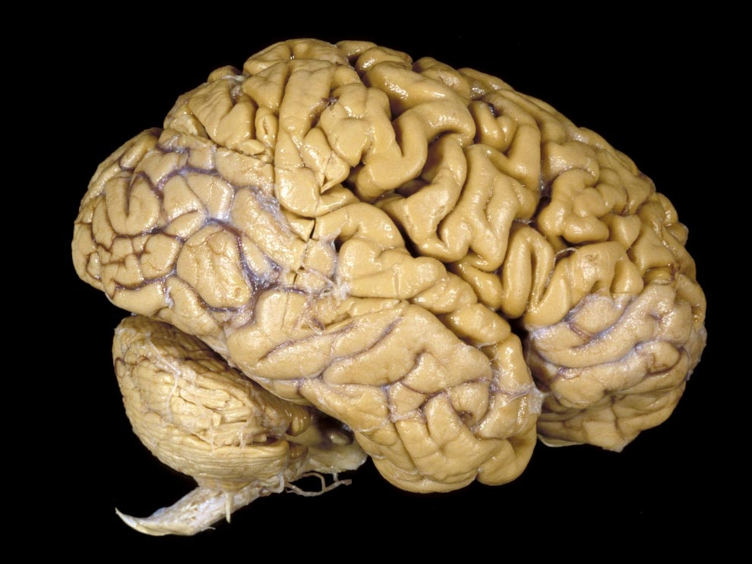 Lateral view of human brain