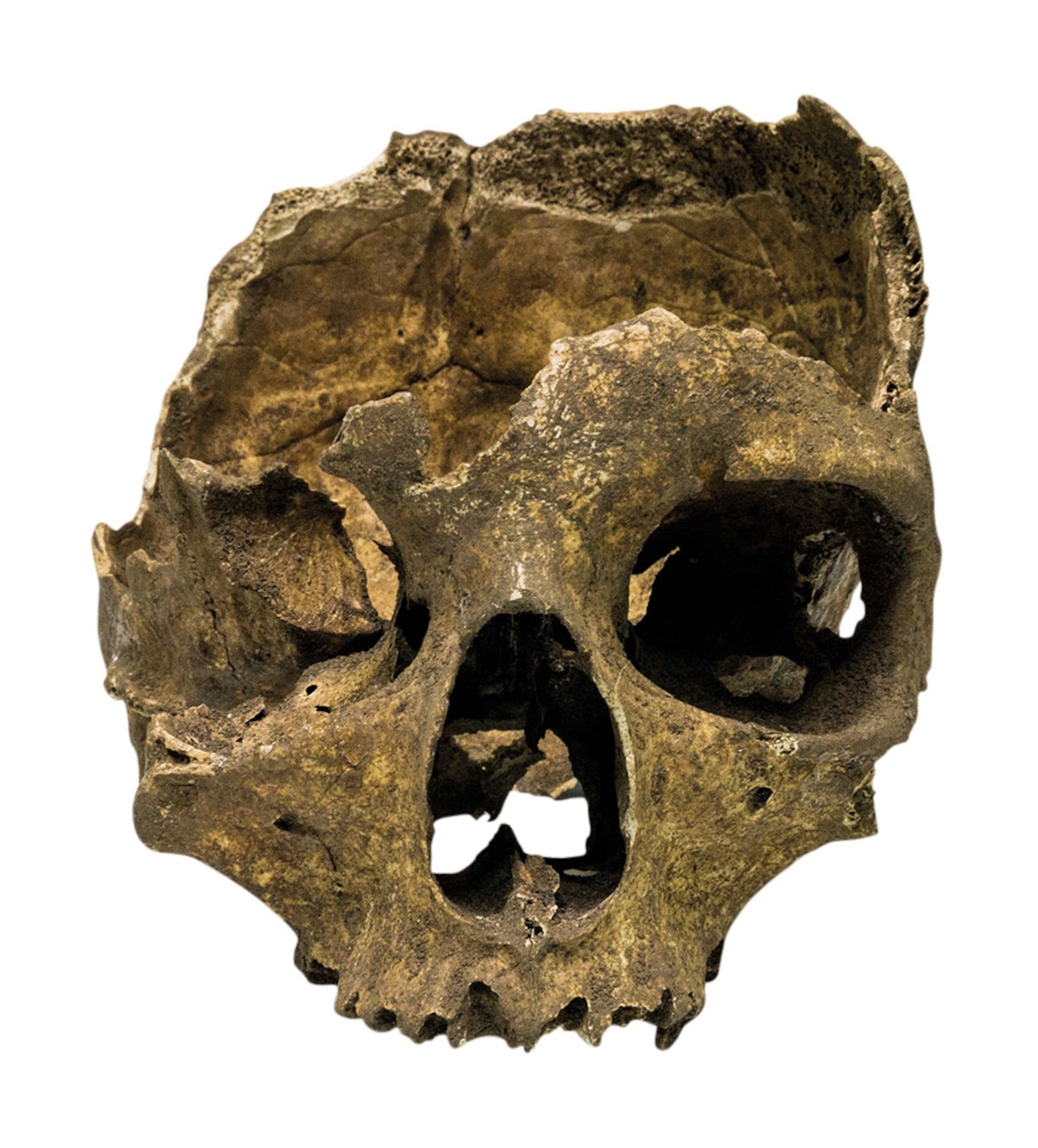 a skull with the top and right eye socket crushed