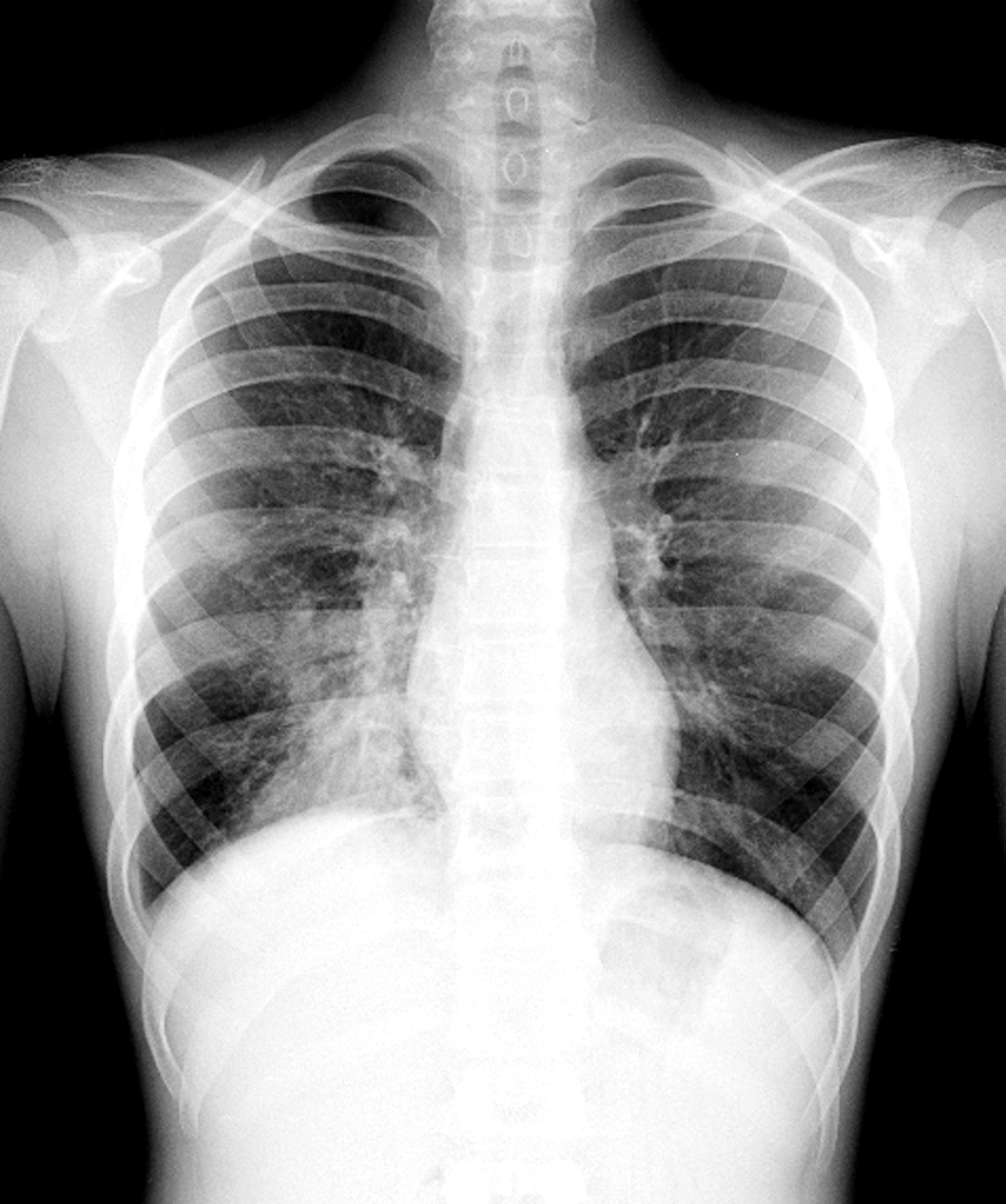 An x-ray showing increased opacity in the right lower lung field, suggestive of pneumonia