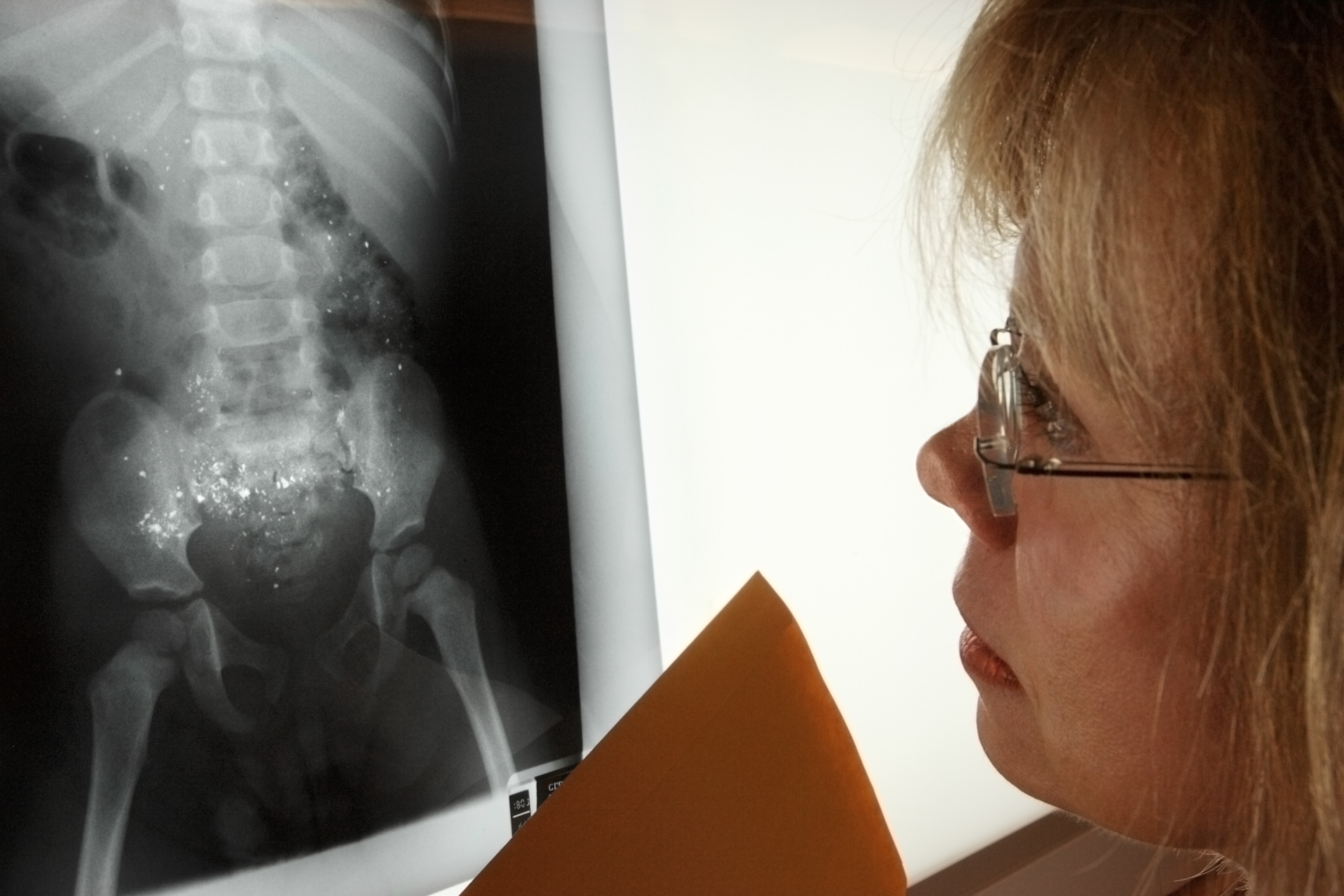 A woman closely examines the xray of a 2-year-old, which shows flecks of lead paint throughout the intestinal tract