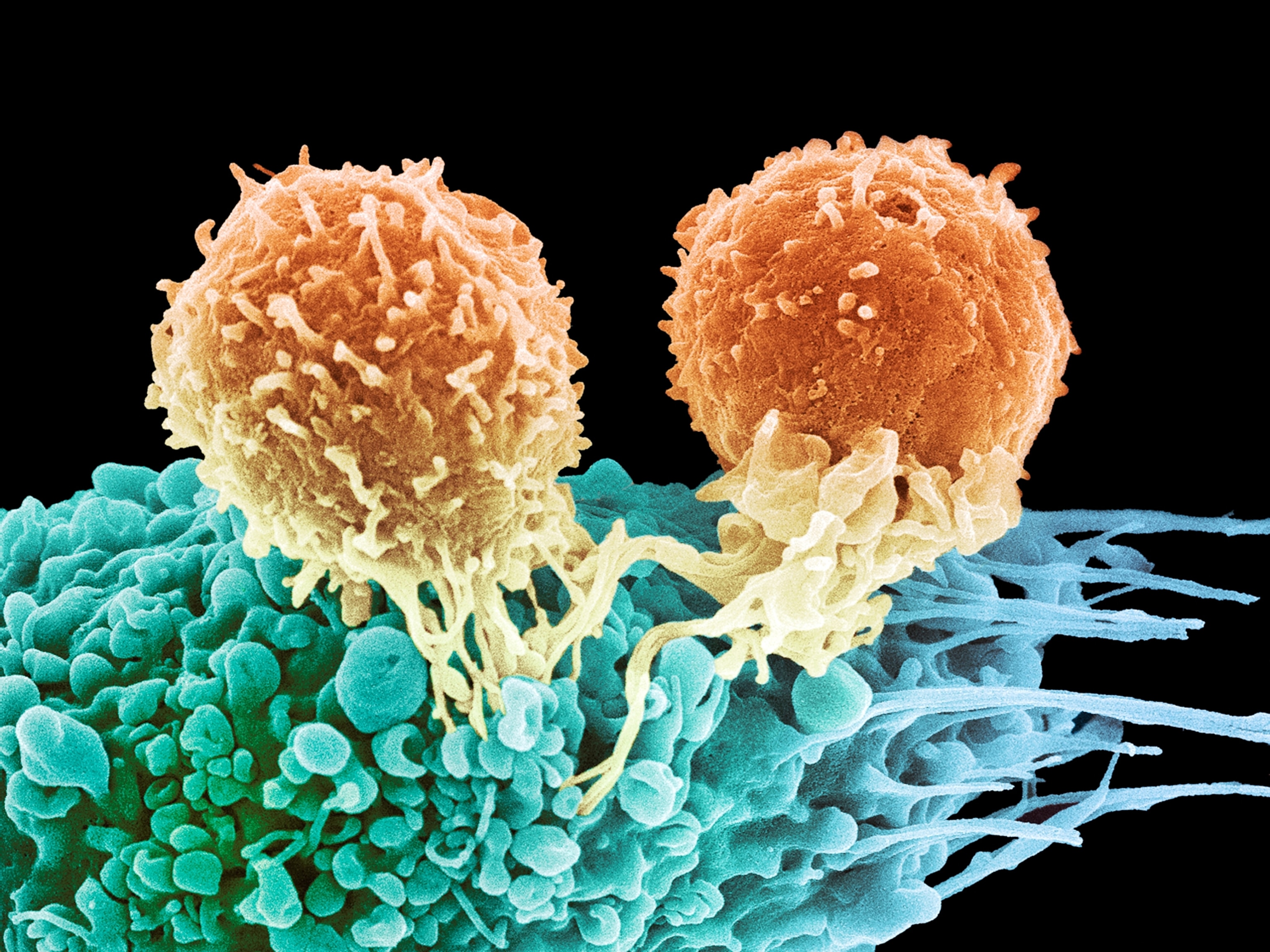 Coloured scanning electron micrograph (SEM) of two T lymphocyte cells attached to a cancer cell