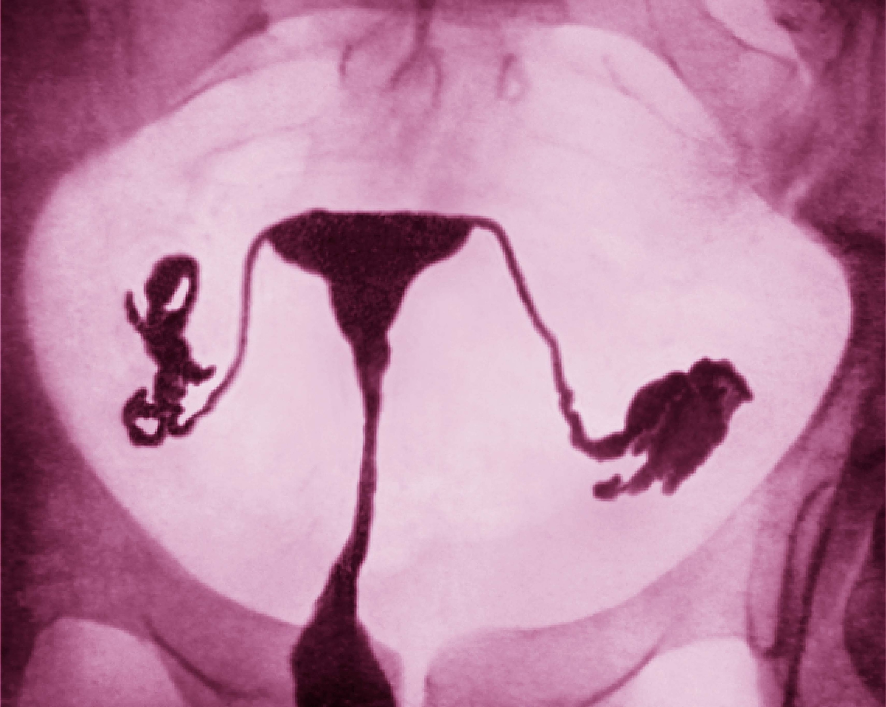 An X-ray image reveals the shape of the female reproductive system, including patent fallopian tubes and uterine cavity.