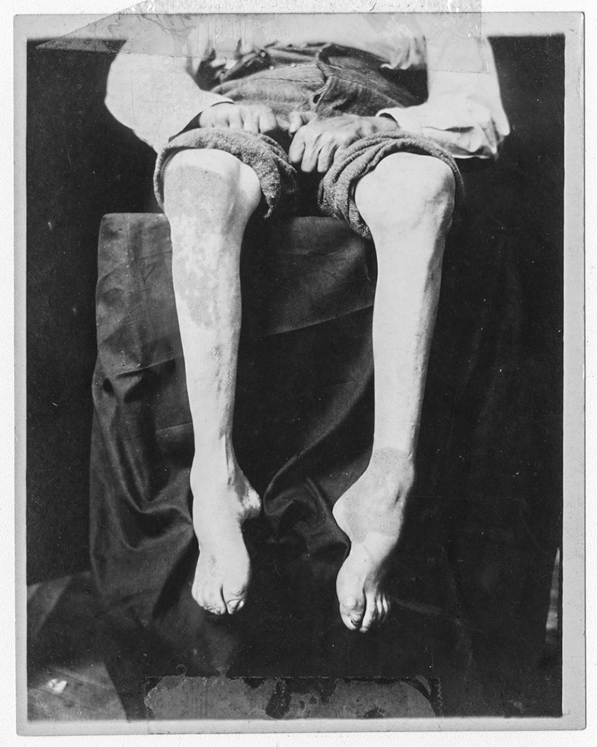 deformed human legs.