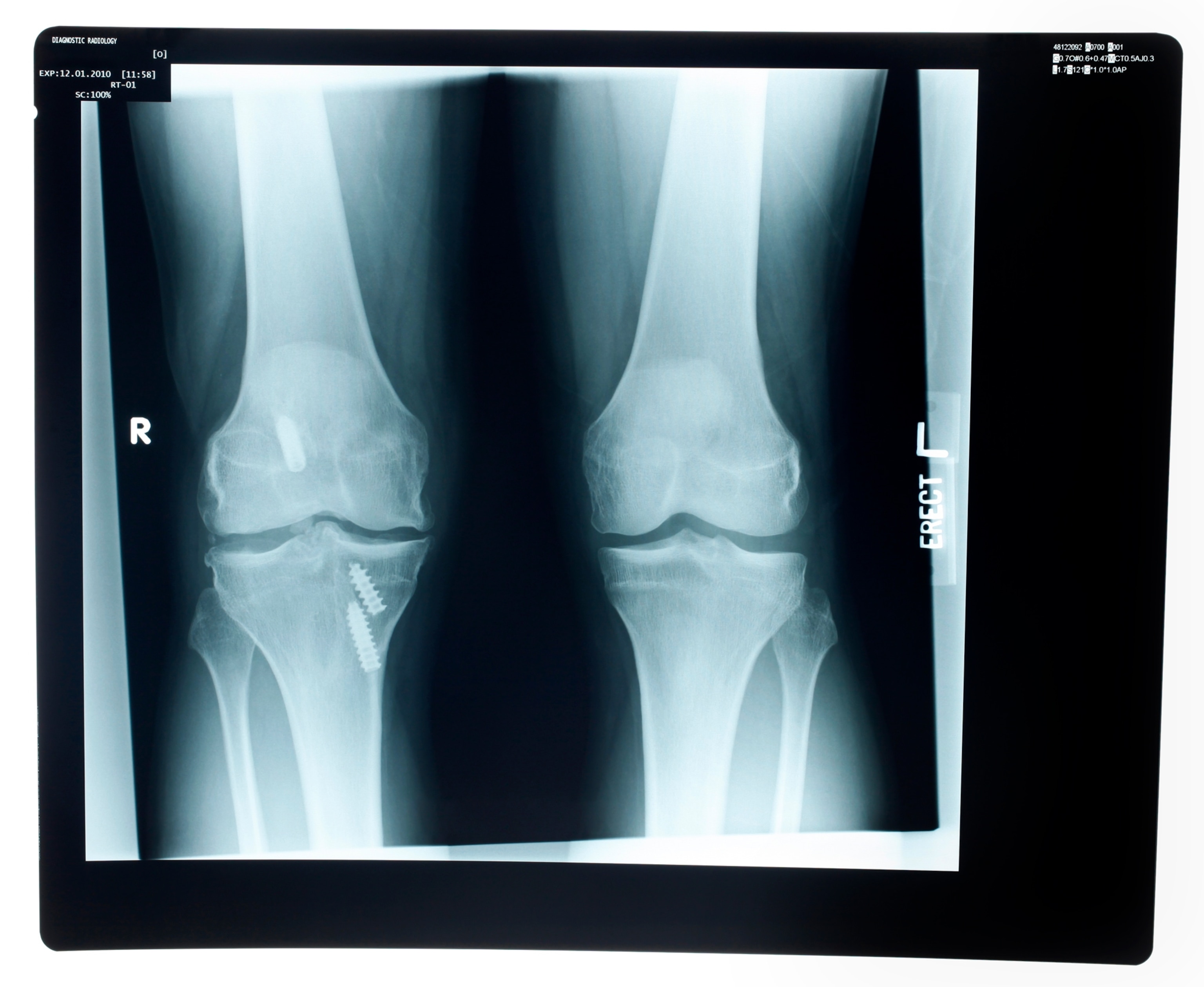 Photo of xray of two knee joints