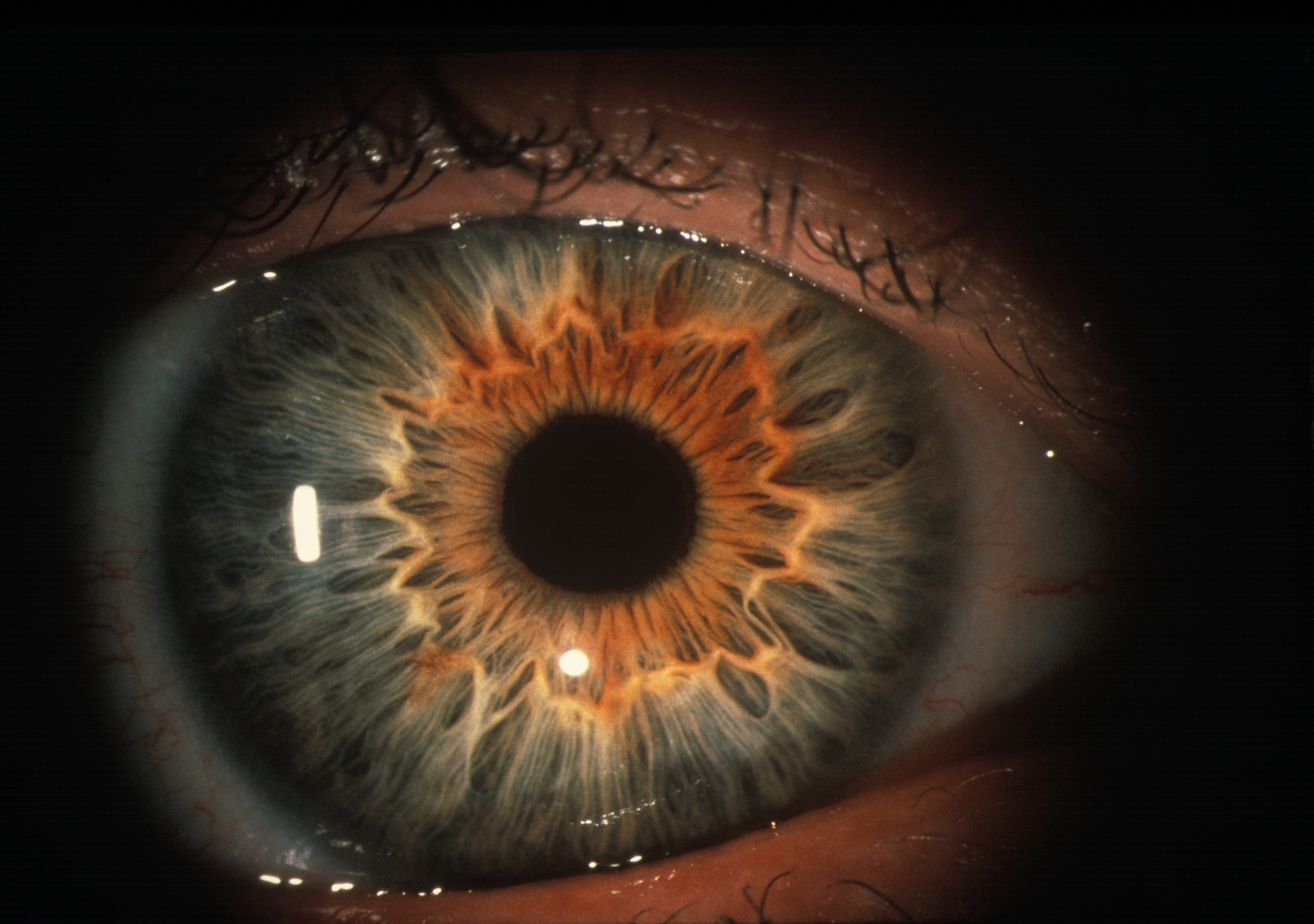 A magnified view of the human eye shows the pupil, the surrounding iris, and capillaries on the surface of the eyeball.
