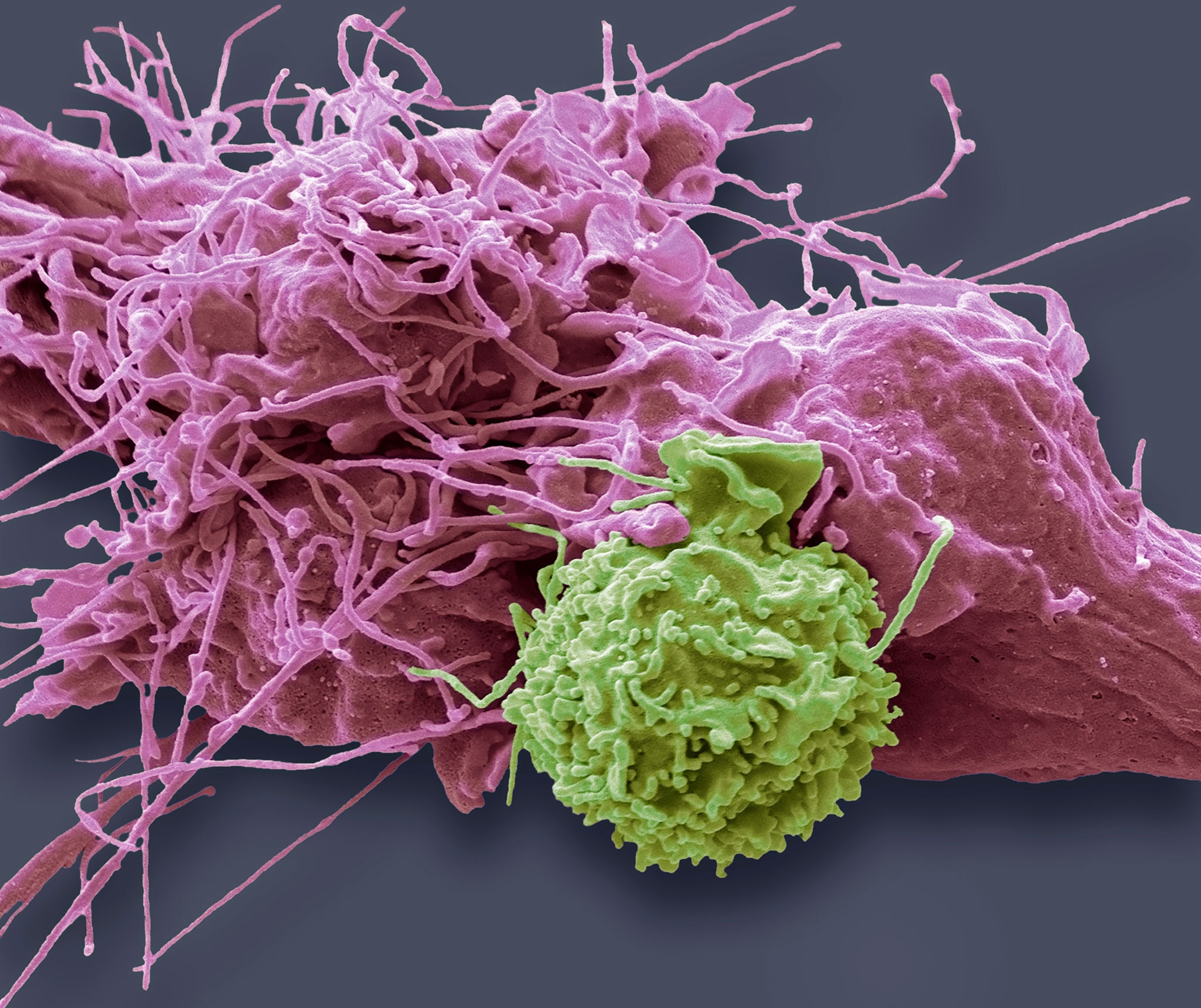 Coloured scanning electron micrograph of Natural Killer cells, green, cultured with HepG2, liver cancer, cells, pink.