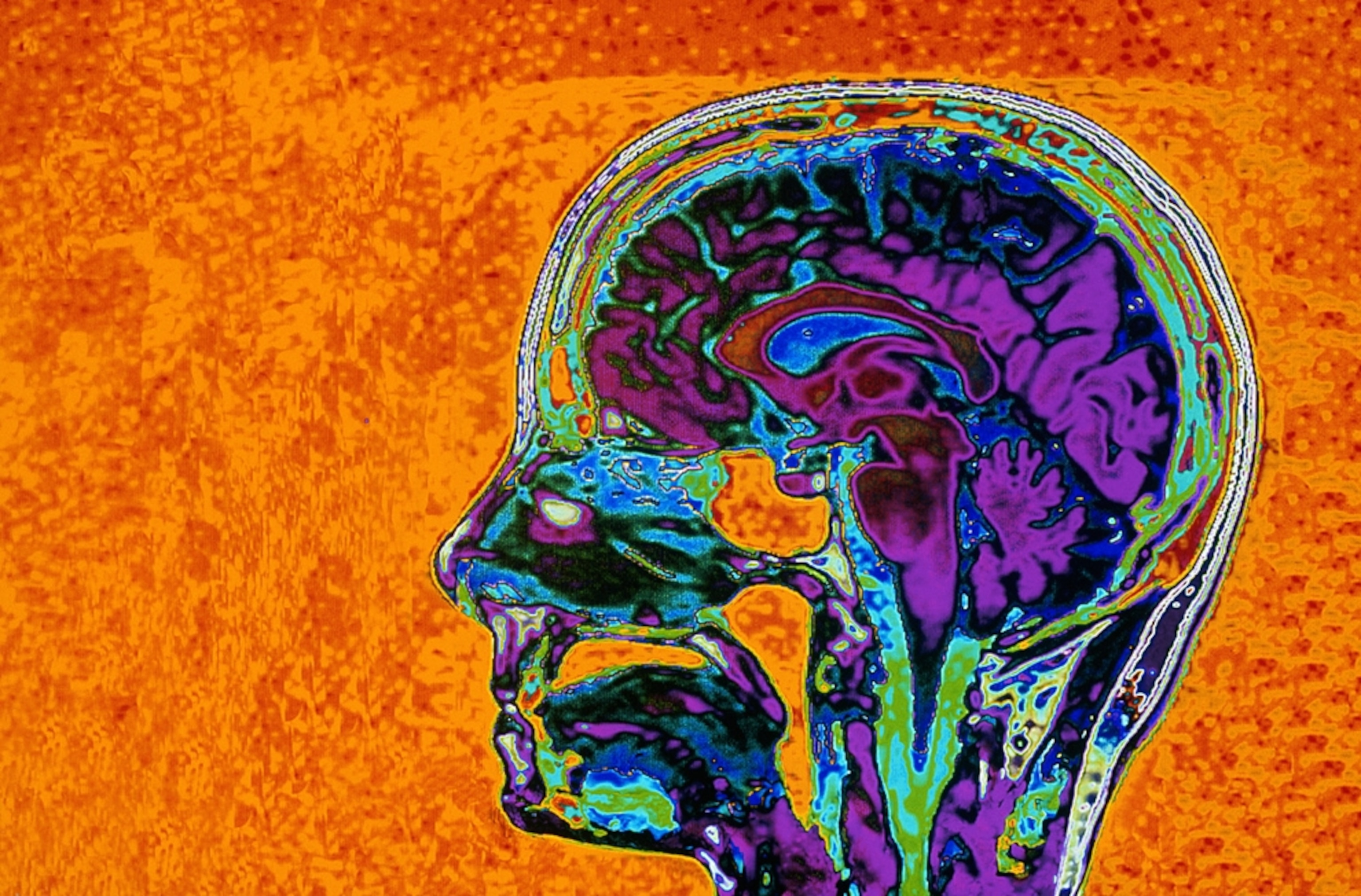 A MRI brain scan.