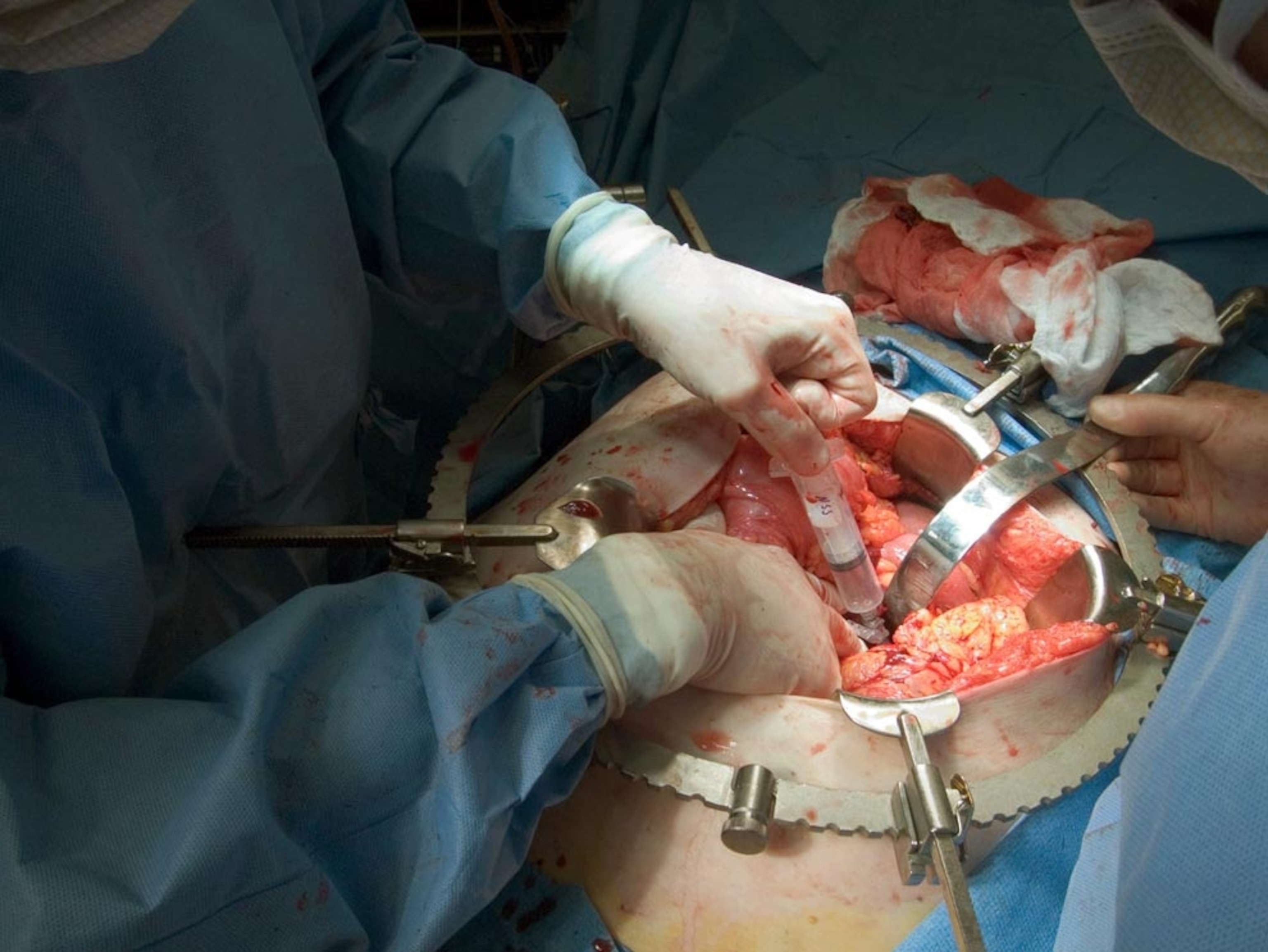 Cyst gastrostomy