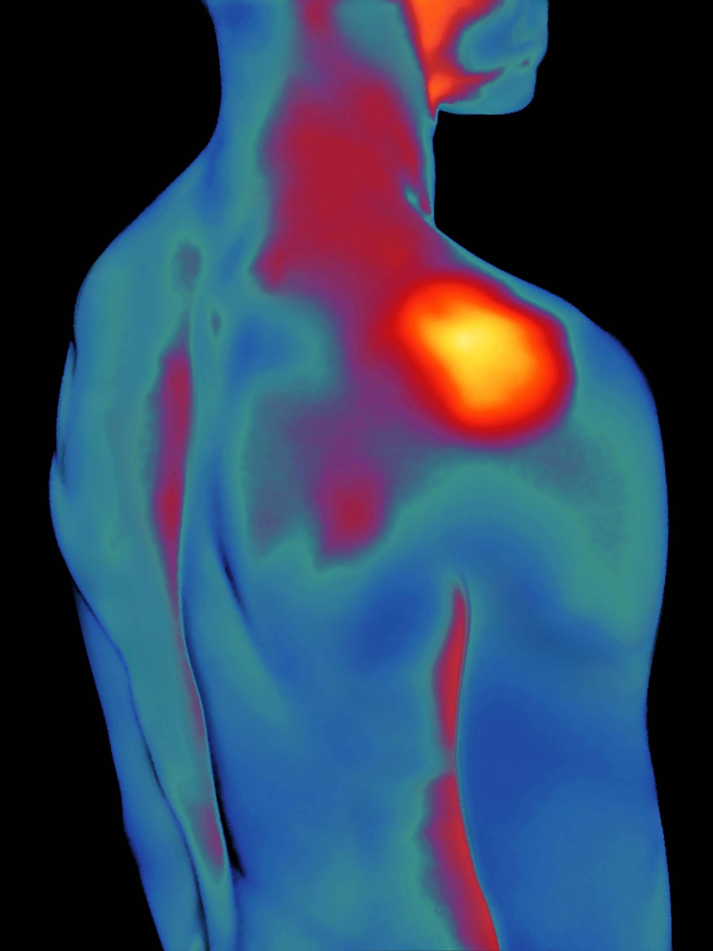 A thermal image of the body from the neck to the waste. The area around the shoulder joint is red and orange, while the other parts of the body or blue.