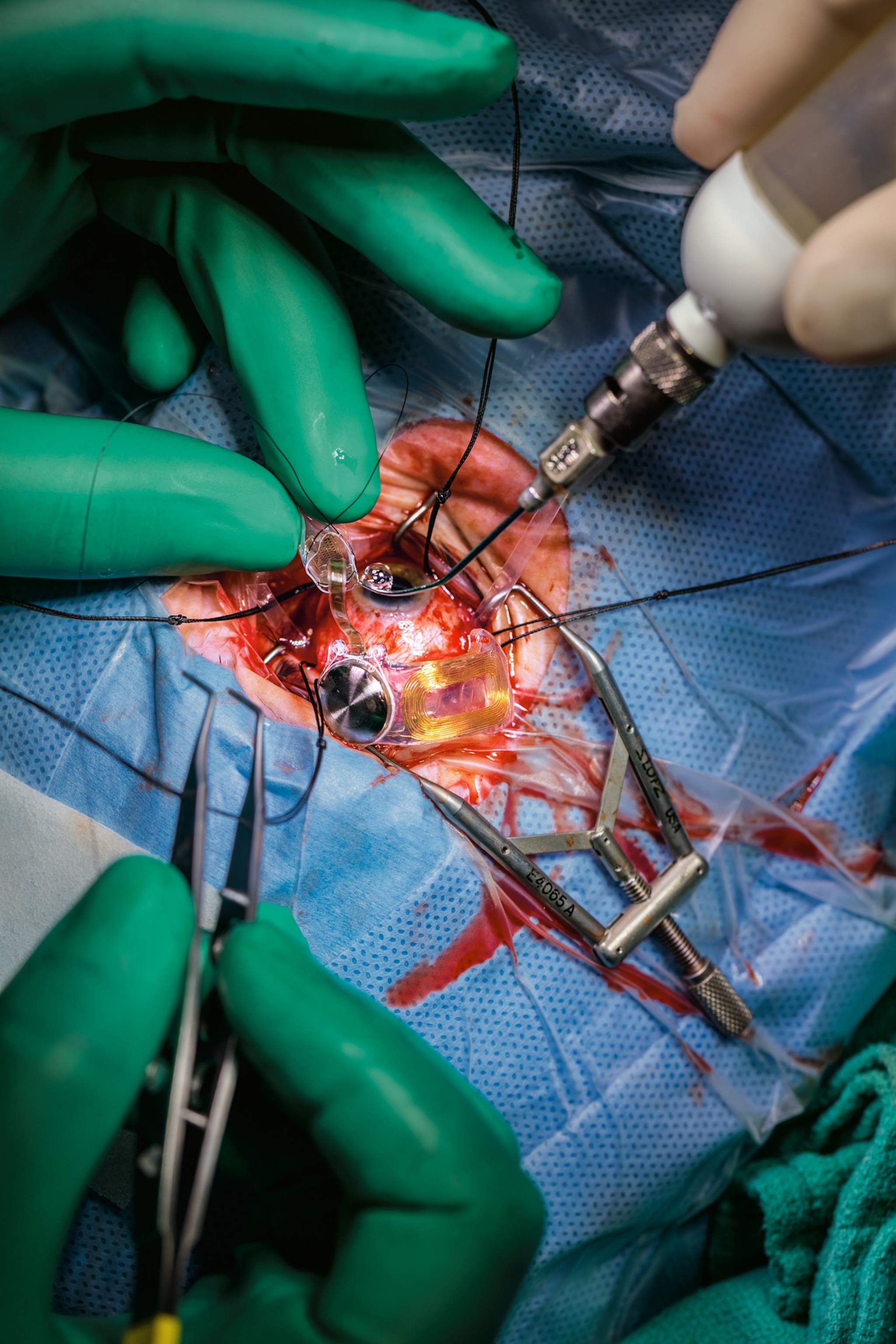 Duke Eye Center surgeons attaching an Argus II implant to the eye of a test subject