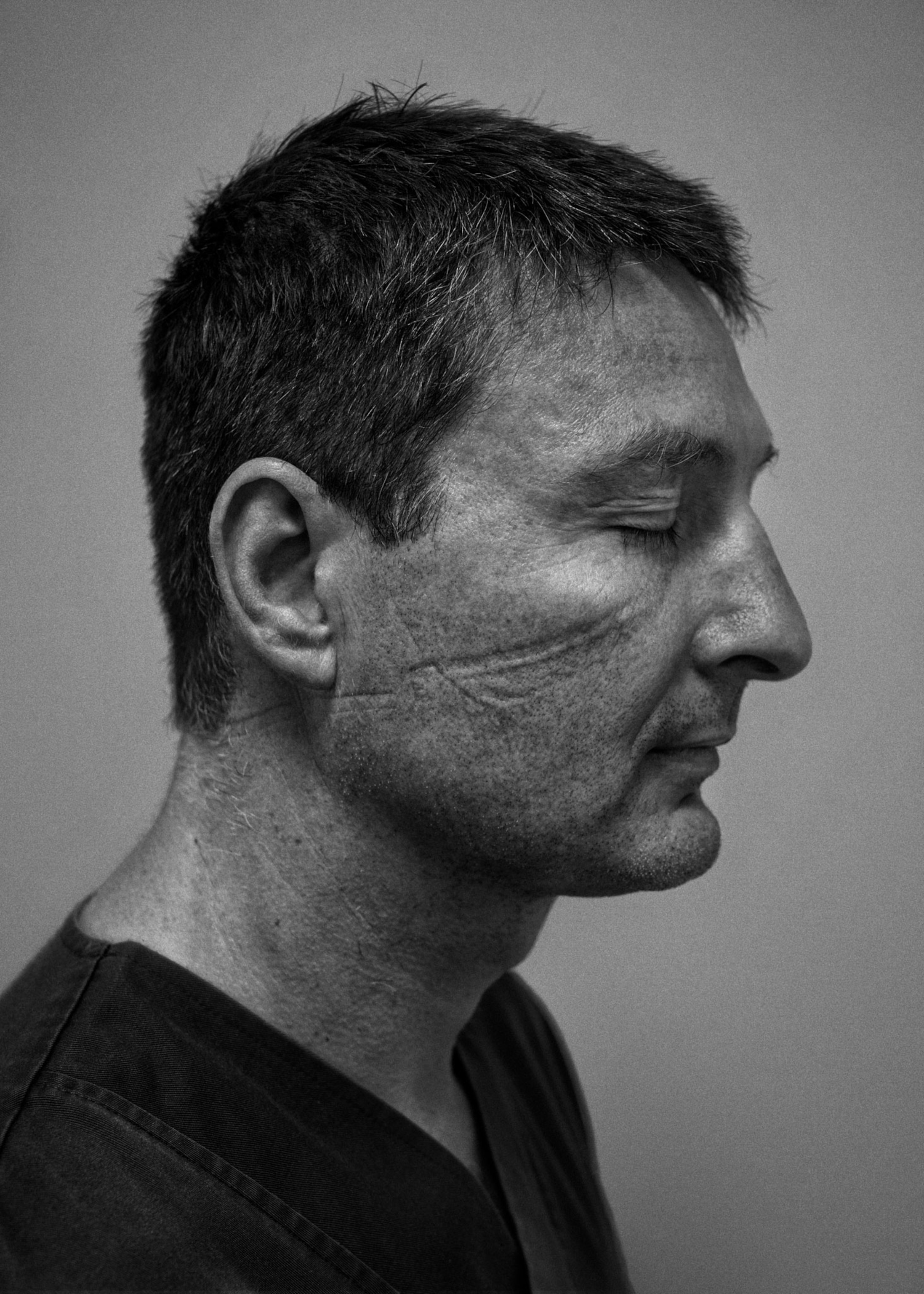 a healthcare worker shows lines on his face from wearing a mask