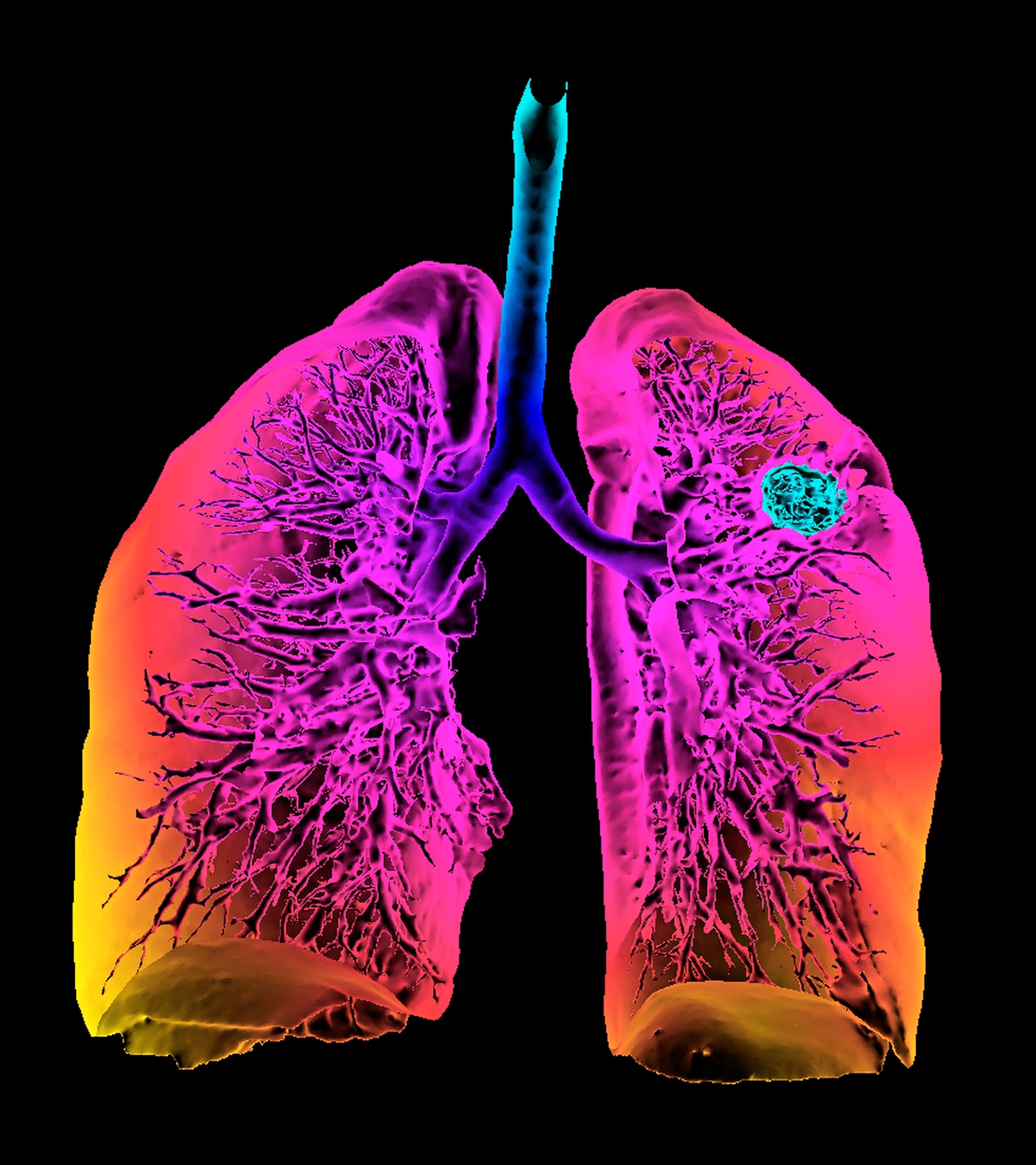 A colorized 3D model of a patient's lungs, highlighting a cancerous lesion in the patient's upper left lung lobe.
