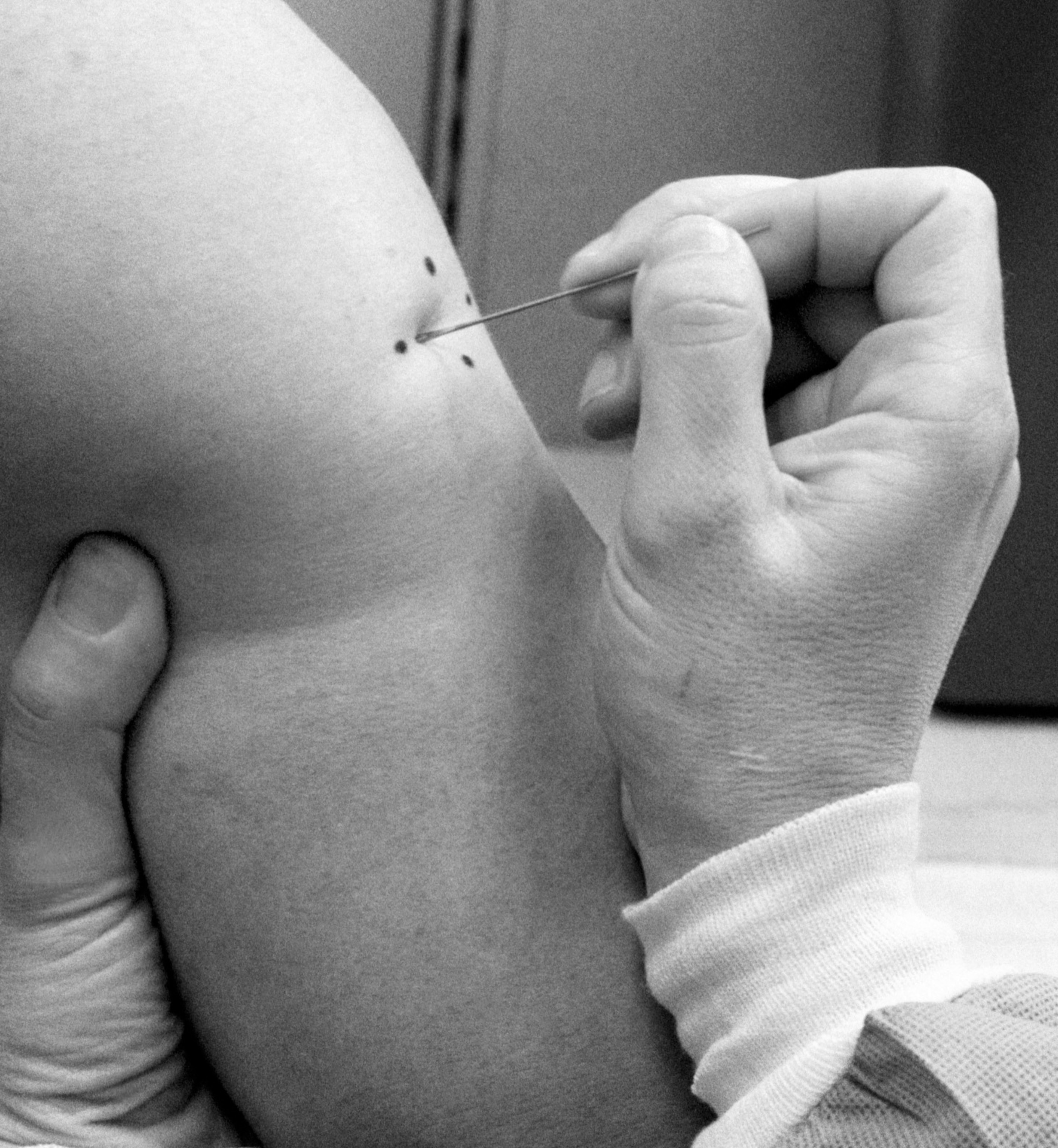 Picture of a smallpox vaccine being administered within a marked portion of a military person's arm.