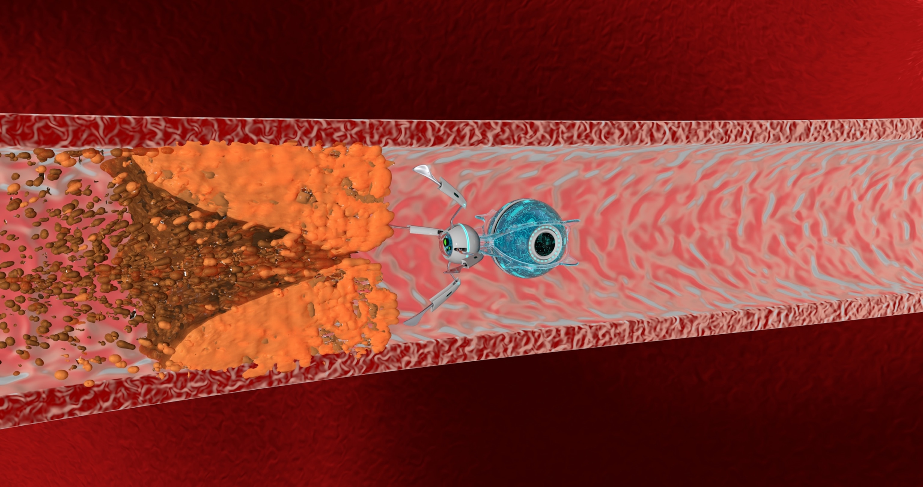 Illustration of small robot breaking up blockage in blood vessel