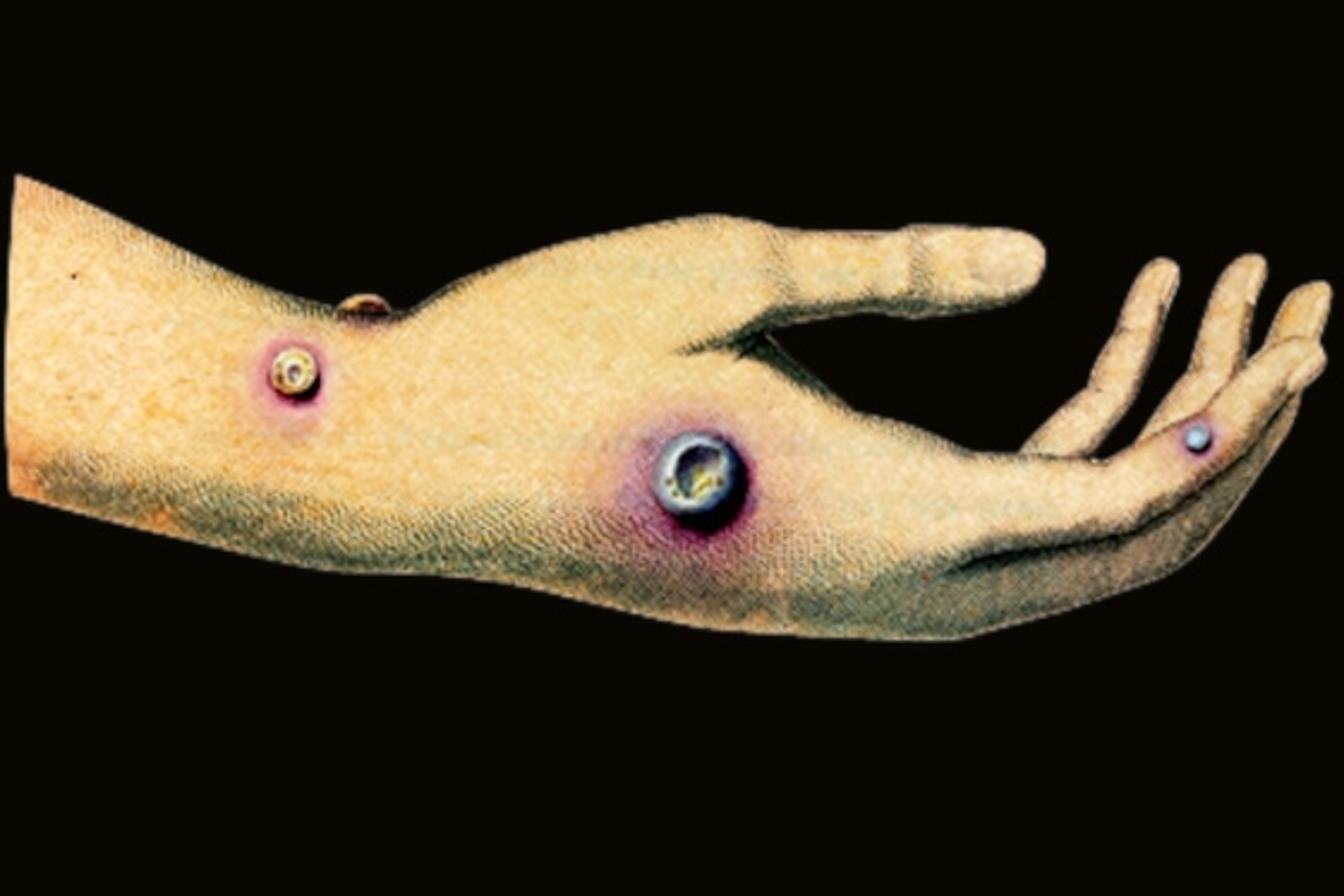 cowpox pustules on the arm of Sarah Nelmes