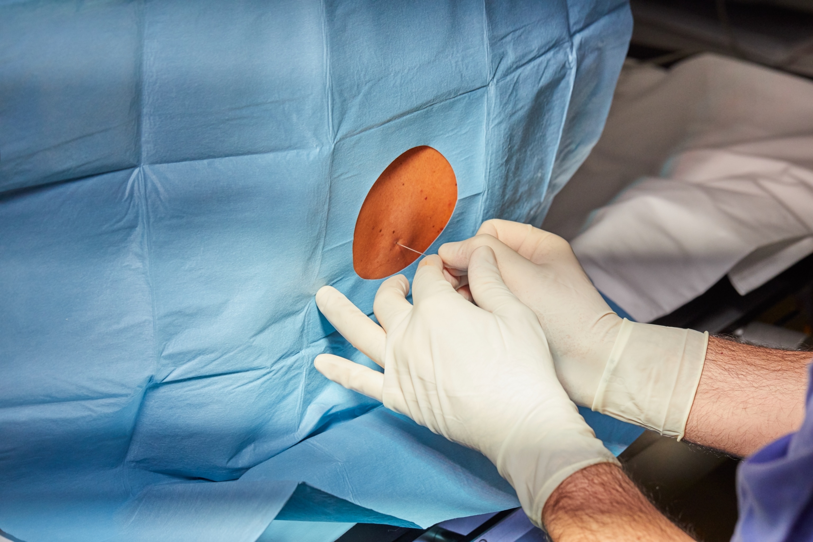 The gloved hands of a doctor carefully inserting an epidural catheter into an exposed portion of a patient's back.