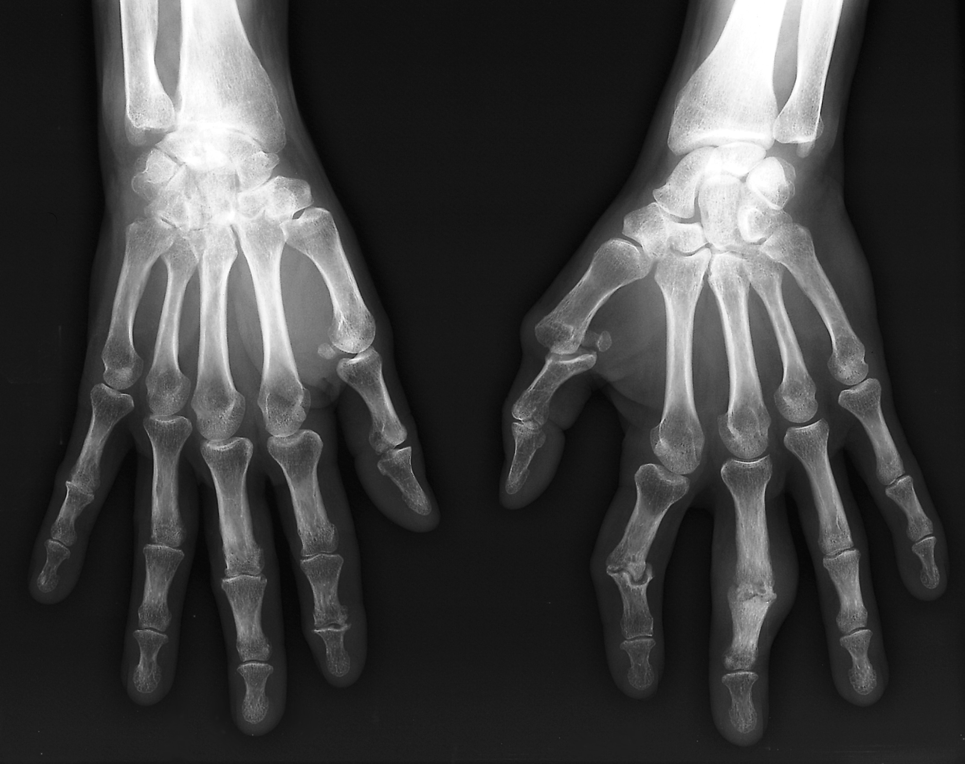 Bilateral X-ray of the hands and wrists of a 54 year old patient with rheumatoid arthritis. On the right hand (left), there is arthritis in the wrist joints.