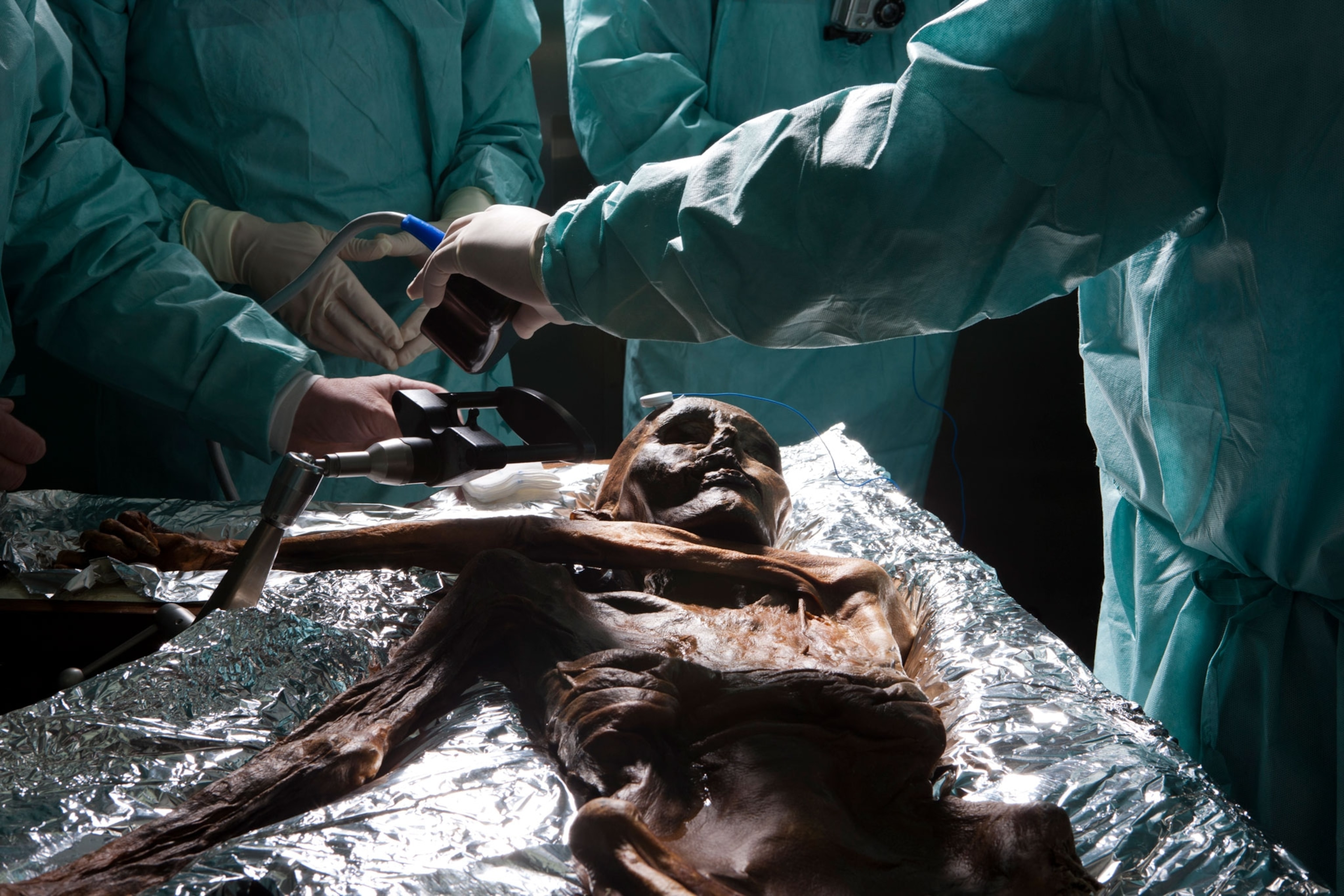 Neurosurgeons take samples from the Iceman's brain.