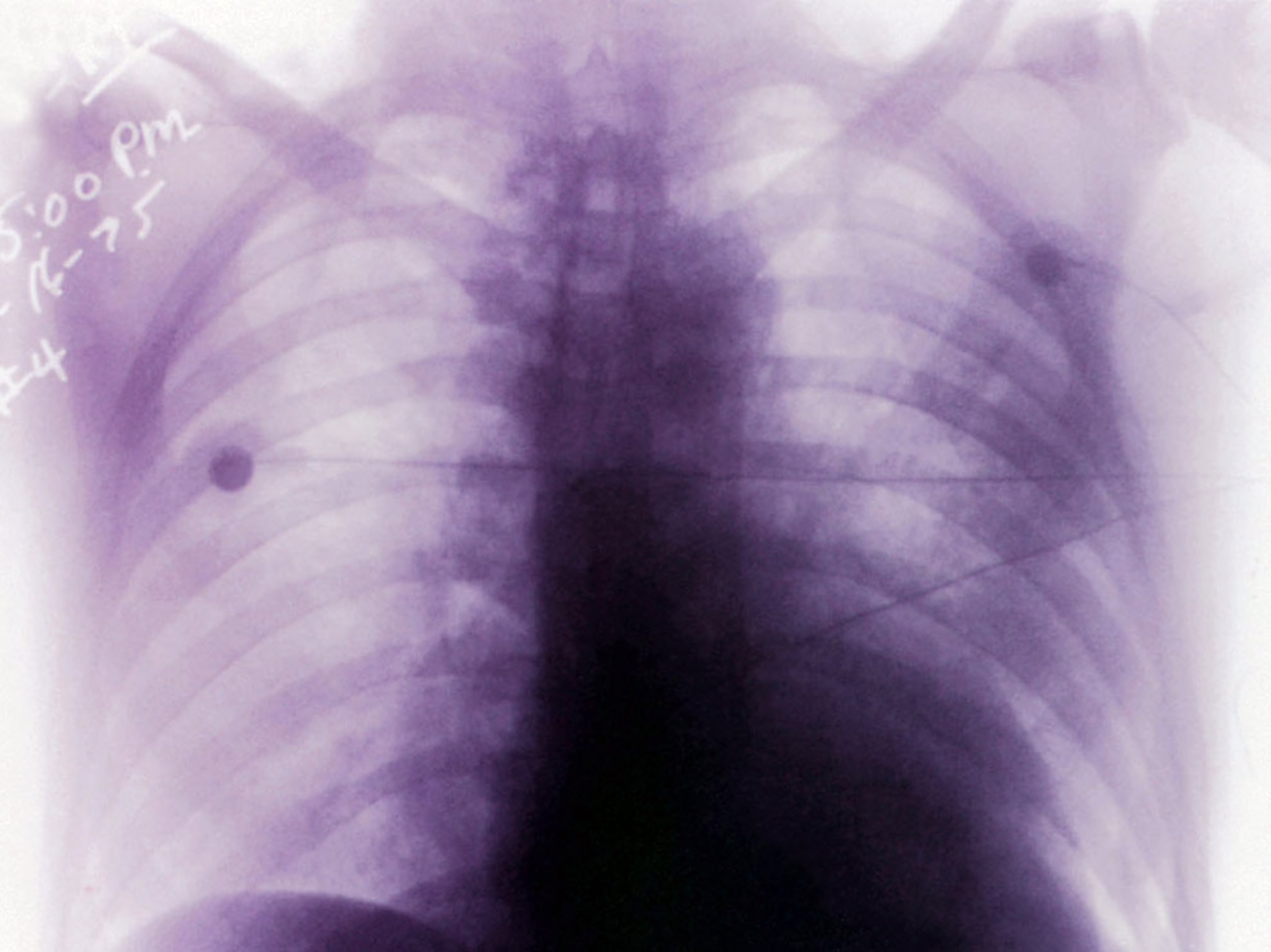 X-ray of pneumonic plague victim's chest