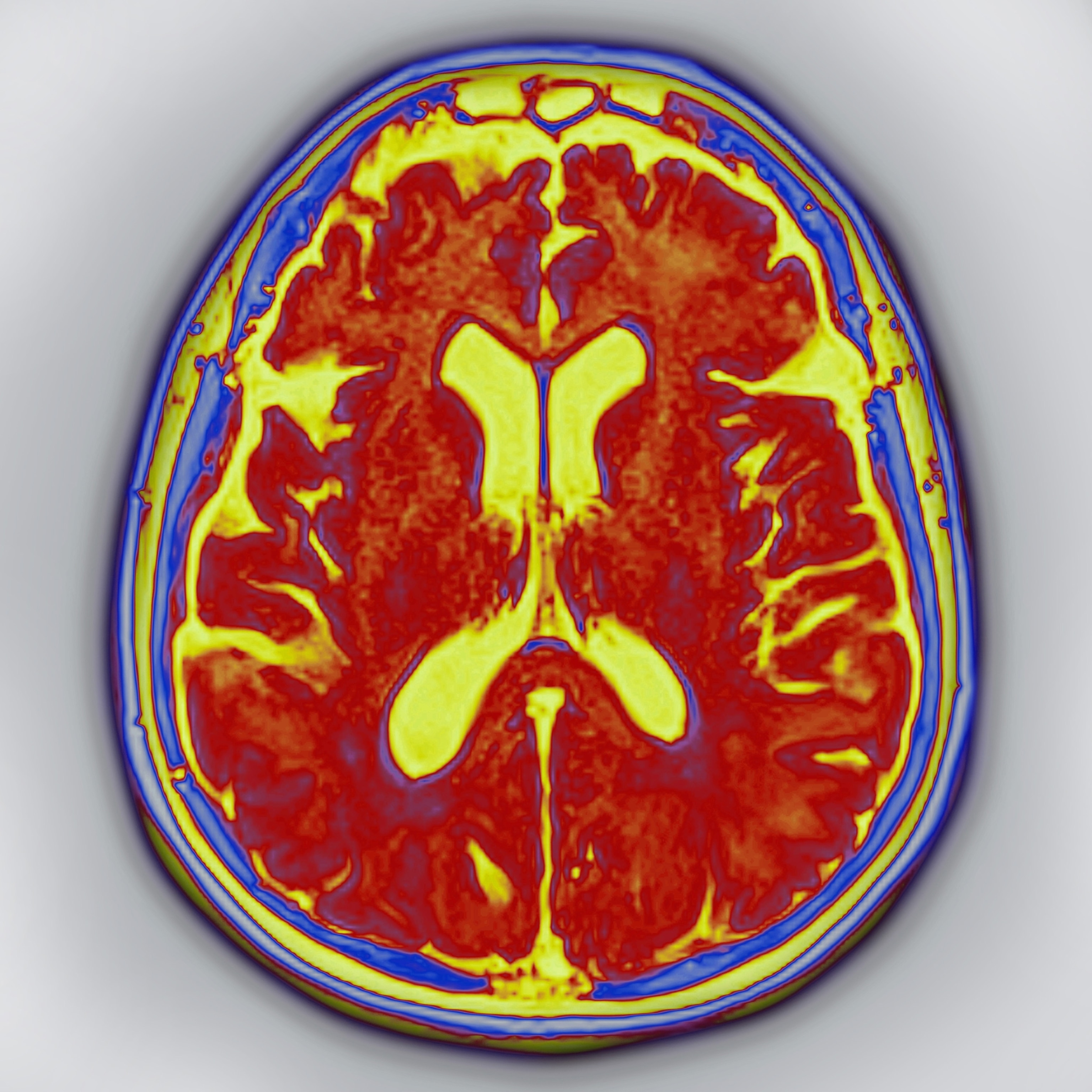 Photo of red and yellow brain scan
