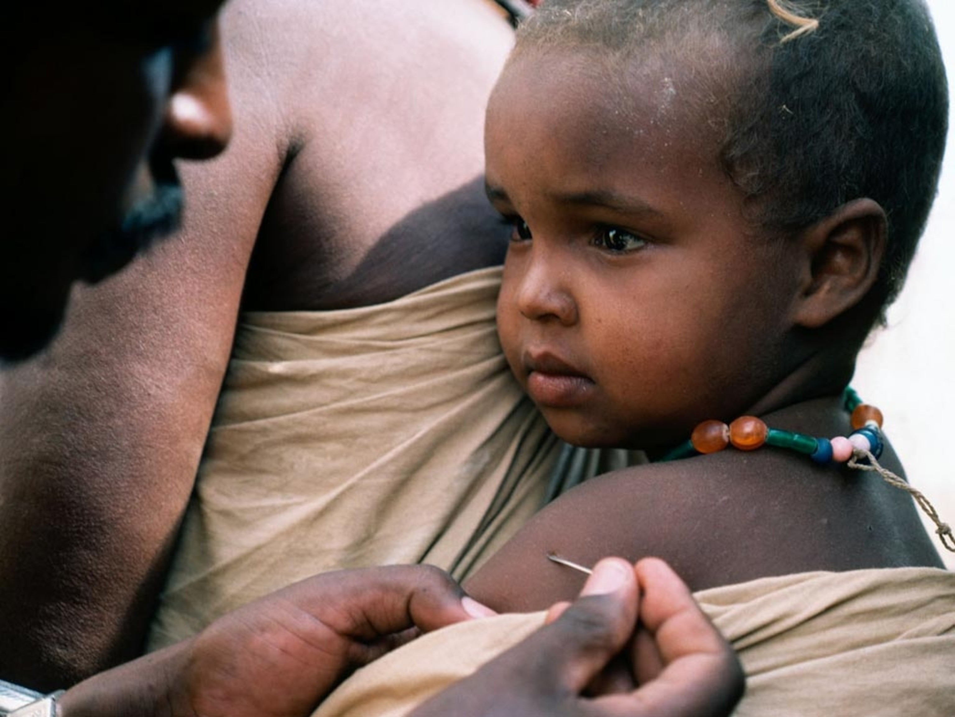 Baby receiving a smallpox vaccination