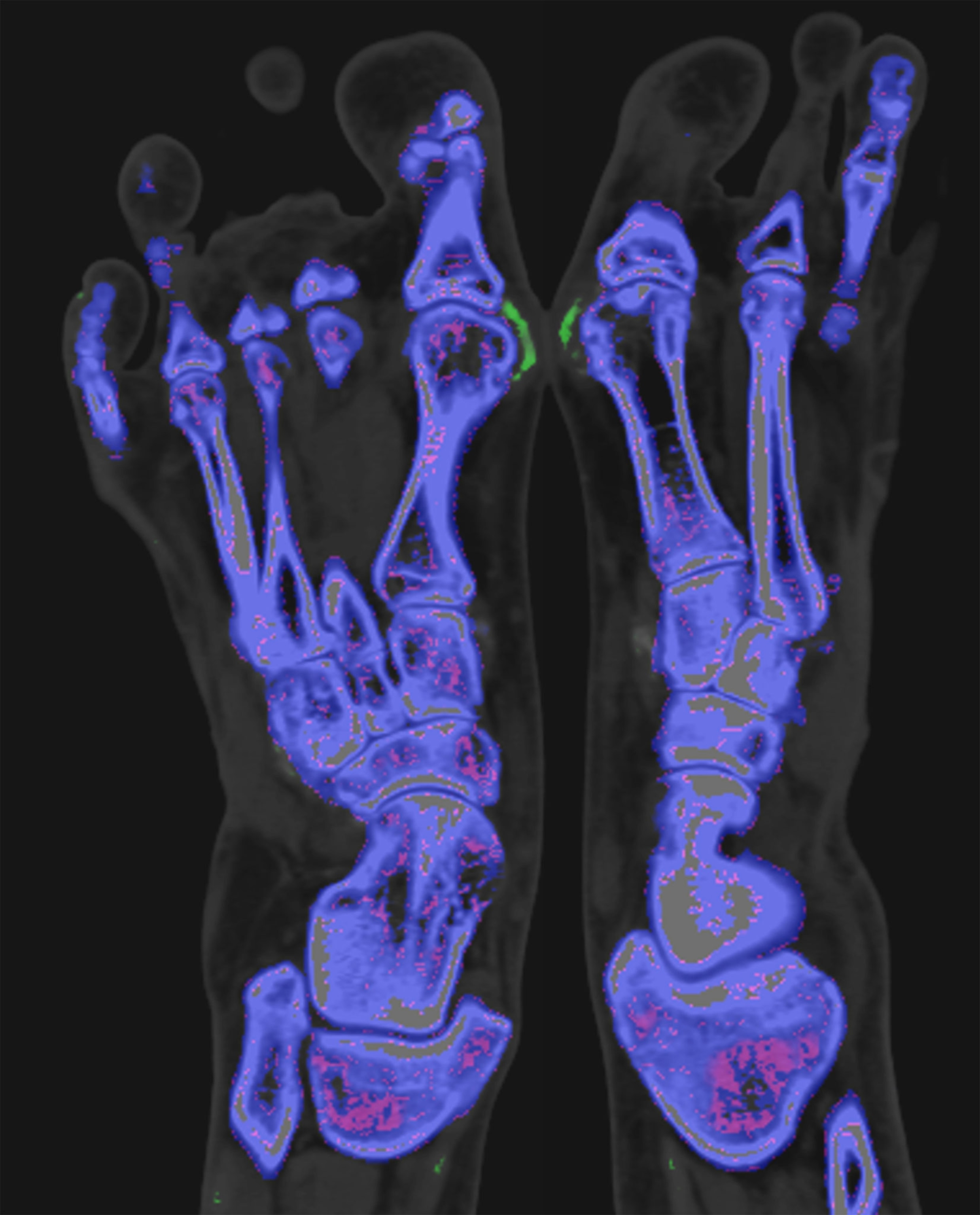 A CT scan of the feet of a woman with gout. Green areas around the joints of the big toe are consistent with gout.
