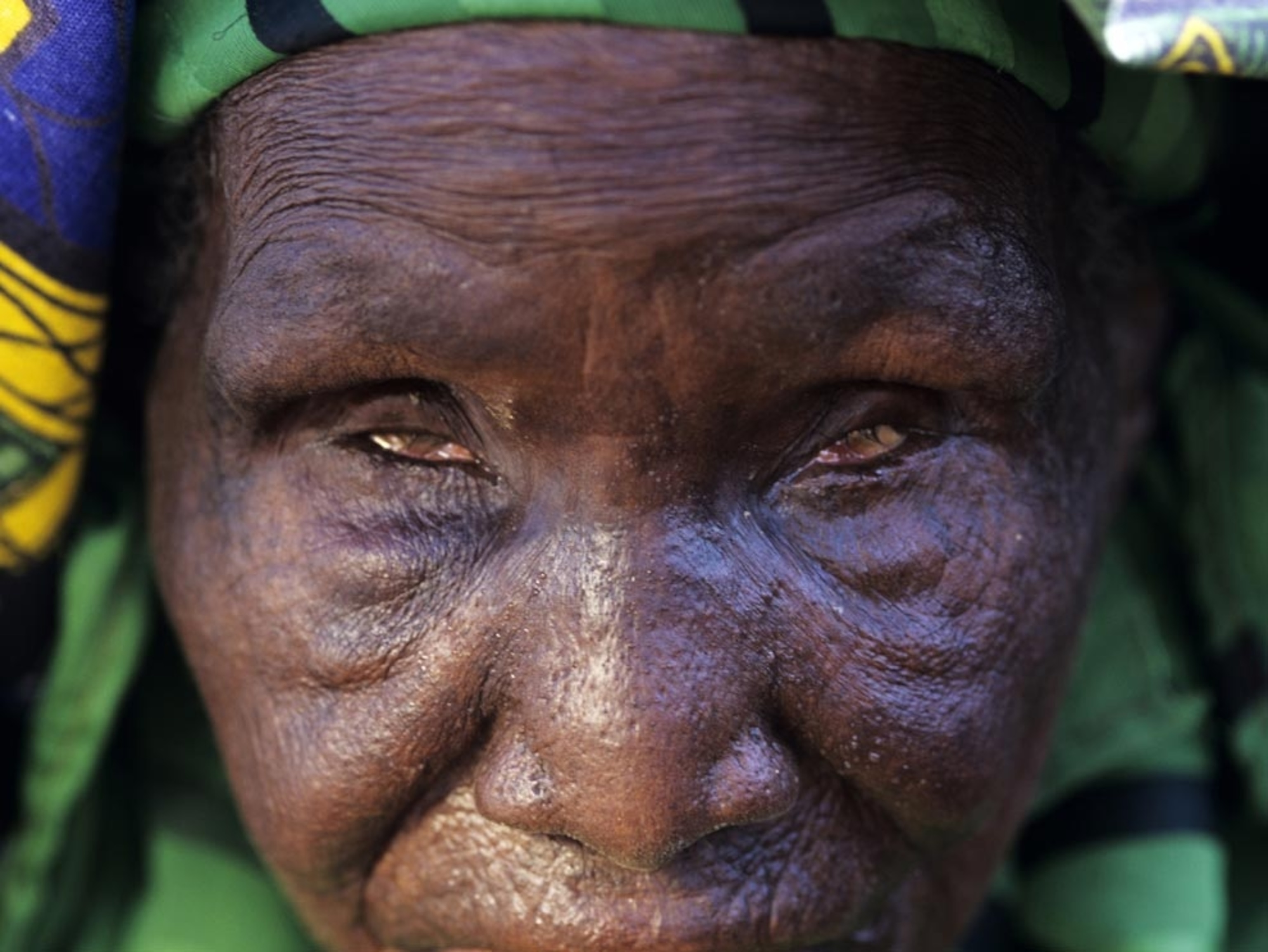A Niger woman's face with eyes blinded by smallpox