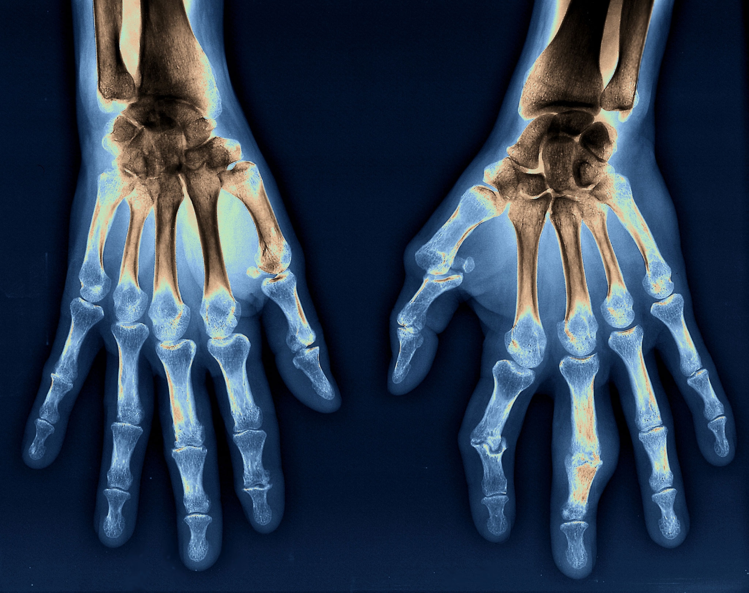 Bilateral x-ray of the hands and wrists of a 54 year old patient with rheumatoid arthritis. The scan, in gradations of blue to brown to black, shows fusing carpometocarpal arthritis of the right hand and bone erosion of the left joint.